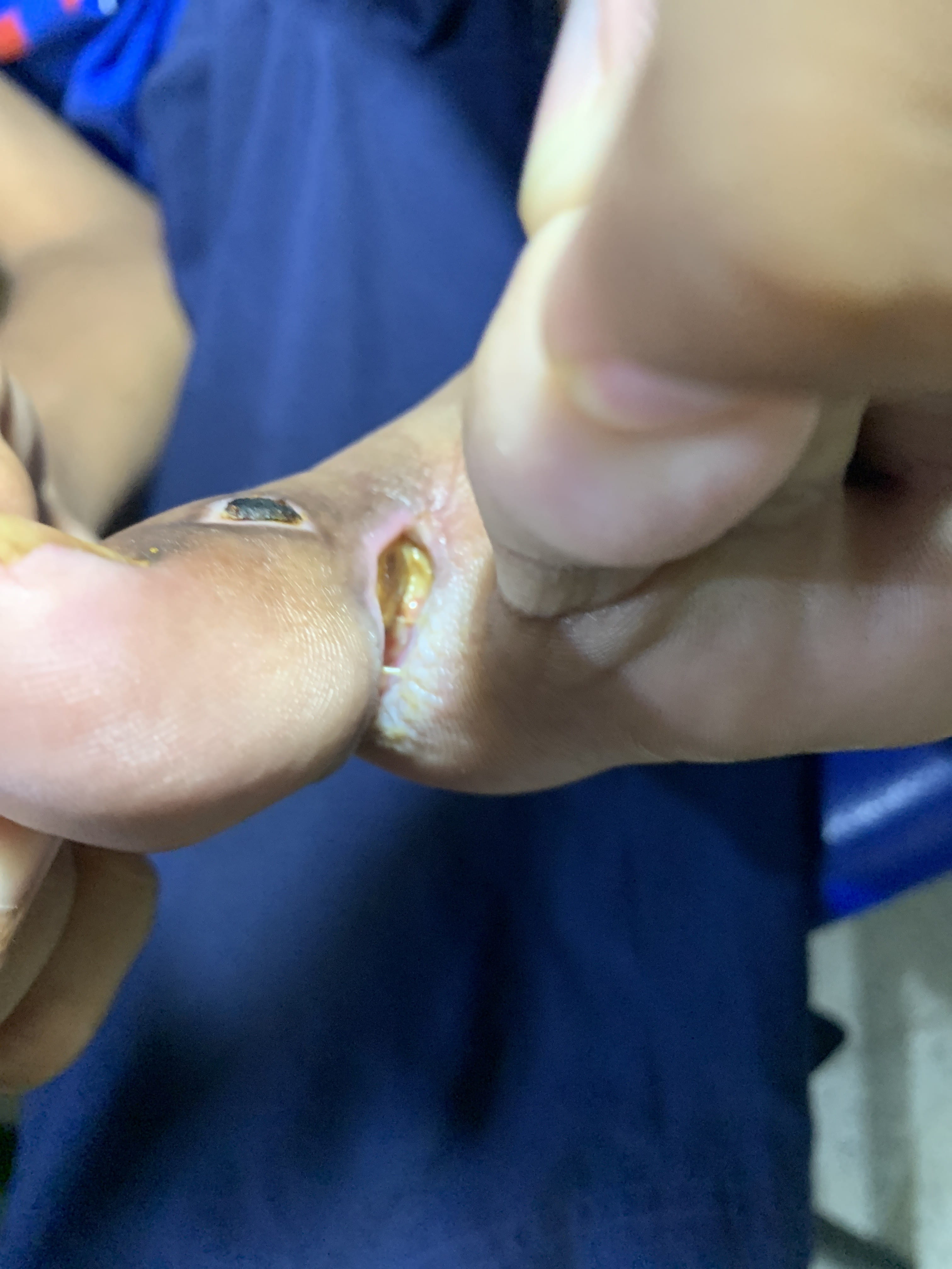 ULCERA post cauterización de Verruga Plantar