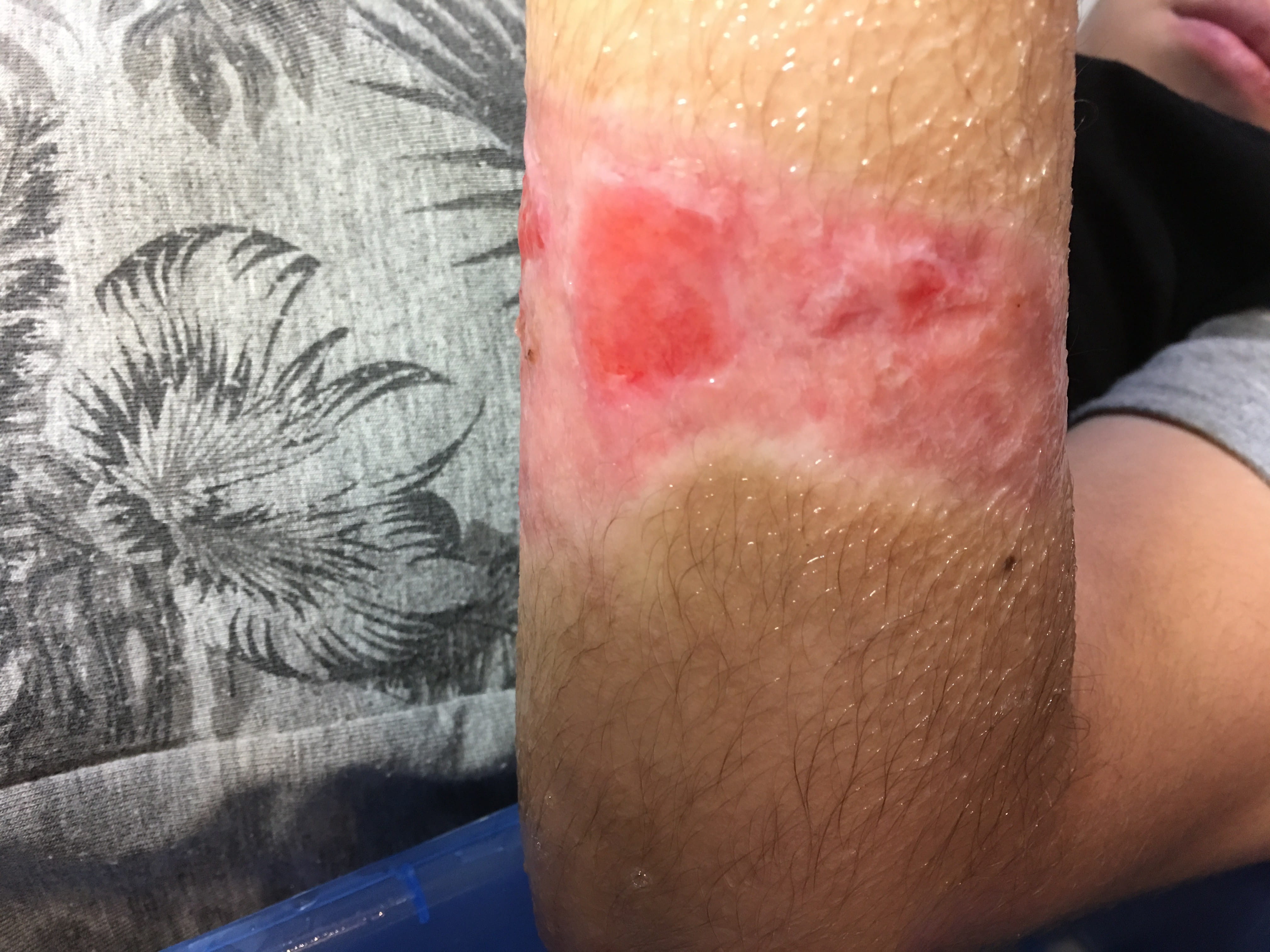 ULCERA post quemadura