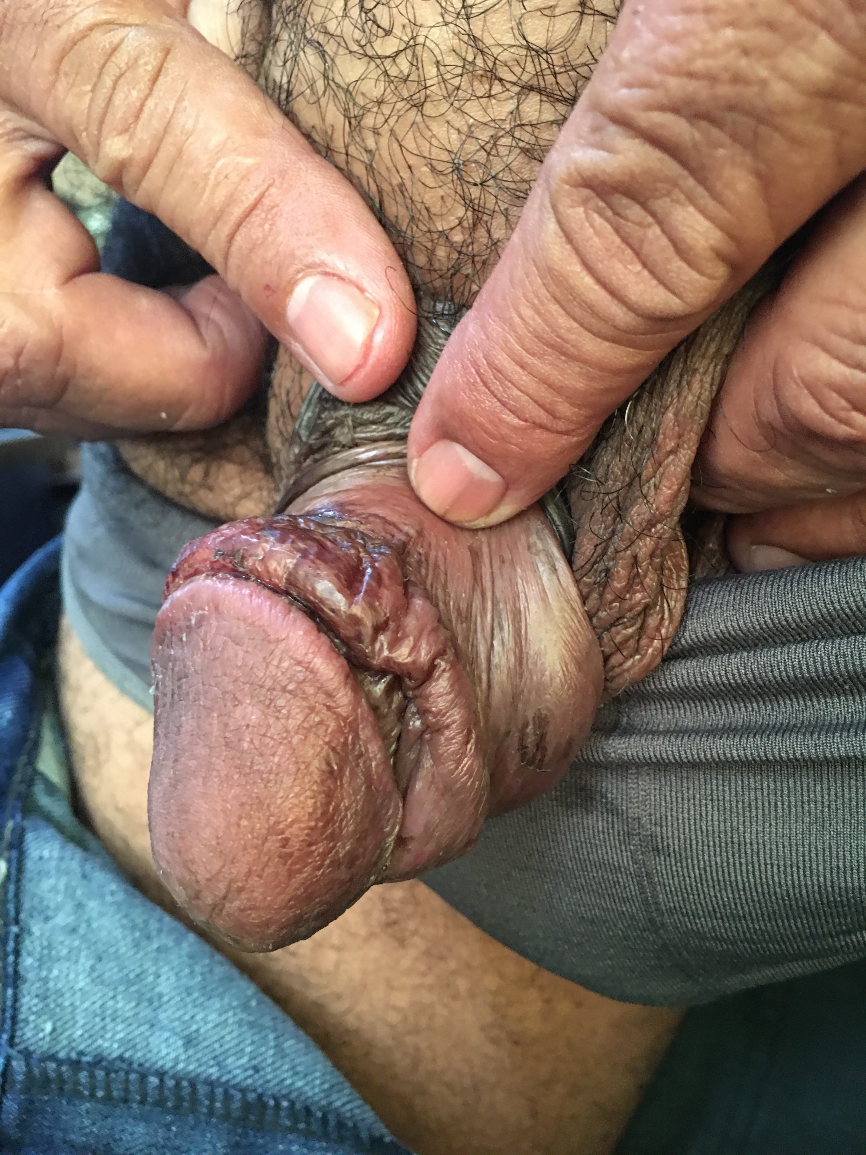 ULCERA post quemadura con Podofilina