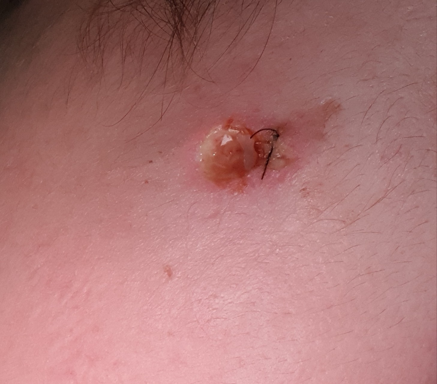 ULCERA por dehsicencia