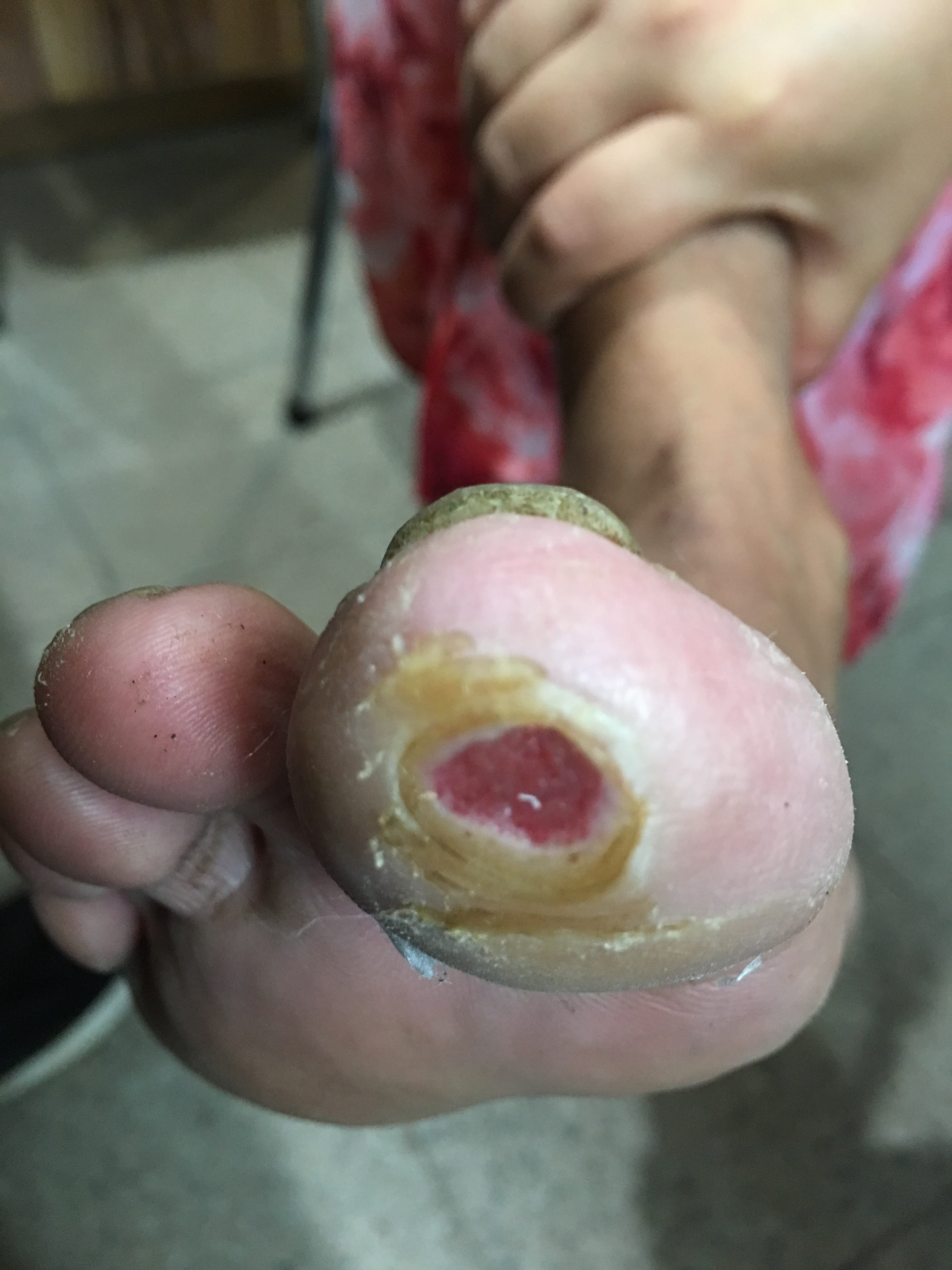 ULCERA pie diabético