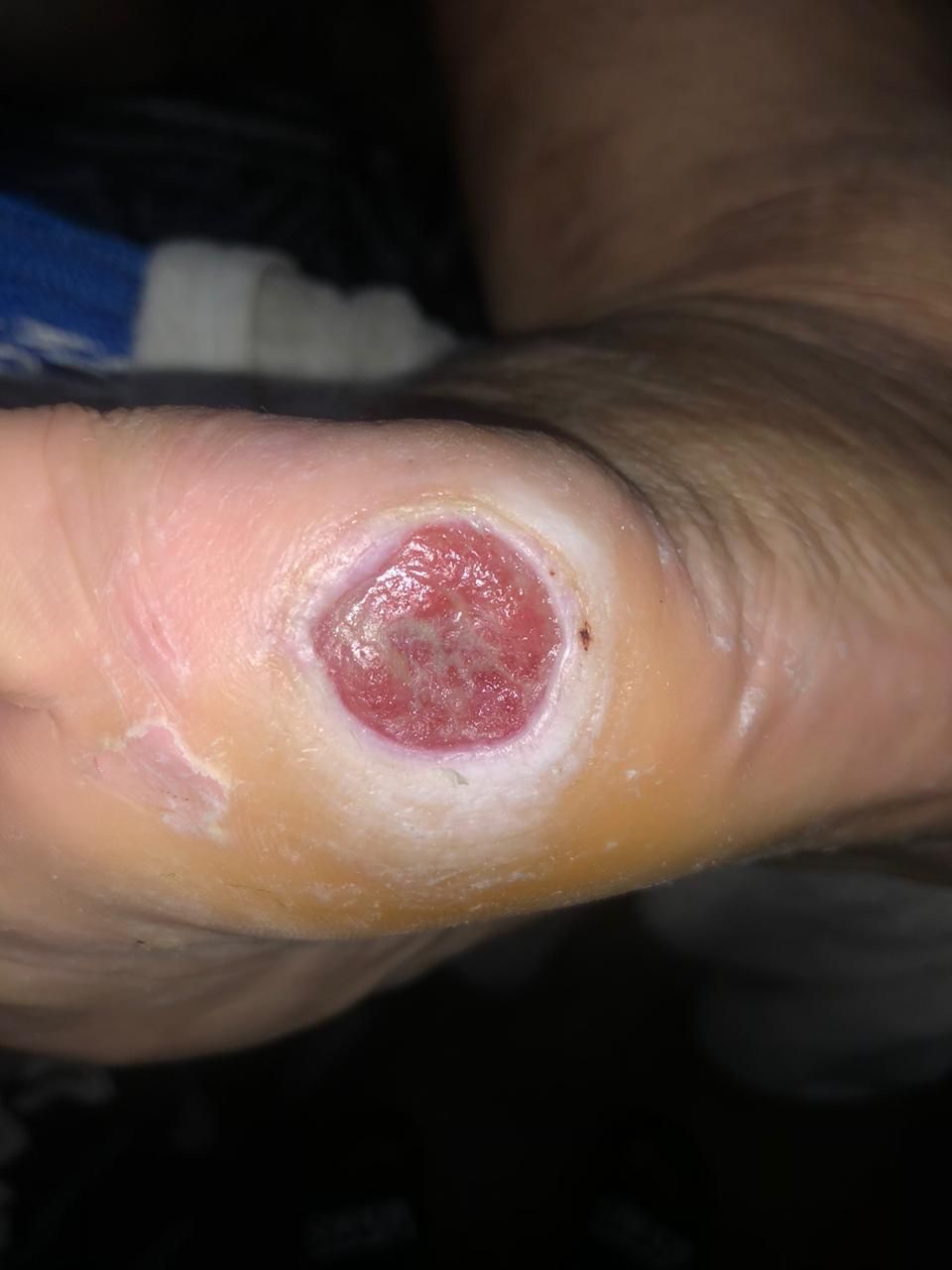 ULCERA pie diabético