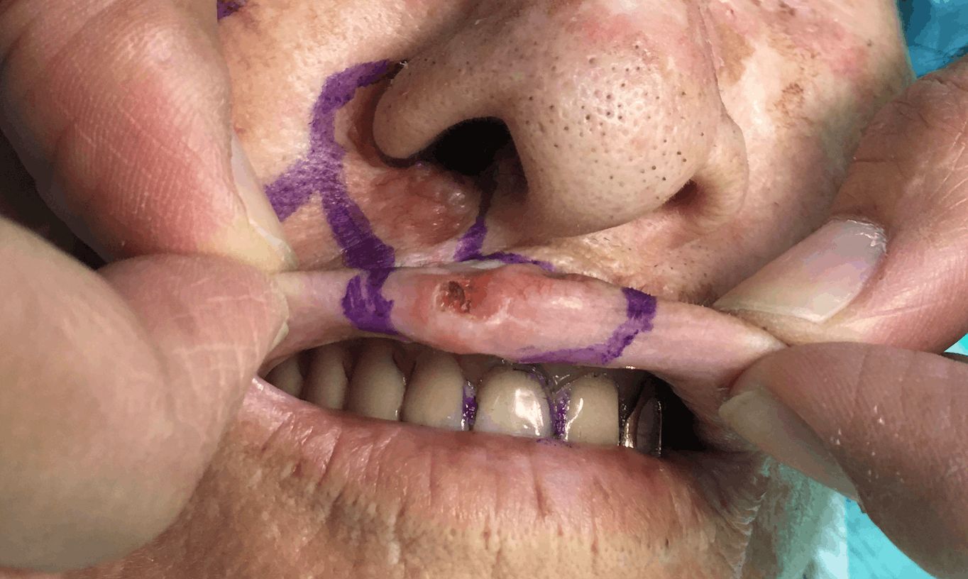 CARCINOMA BASOCELULAR del labio