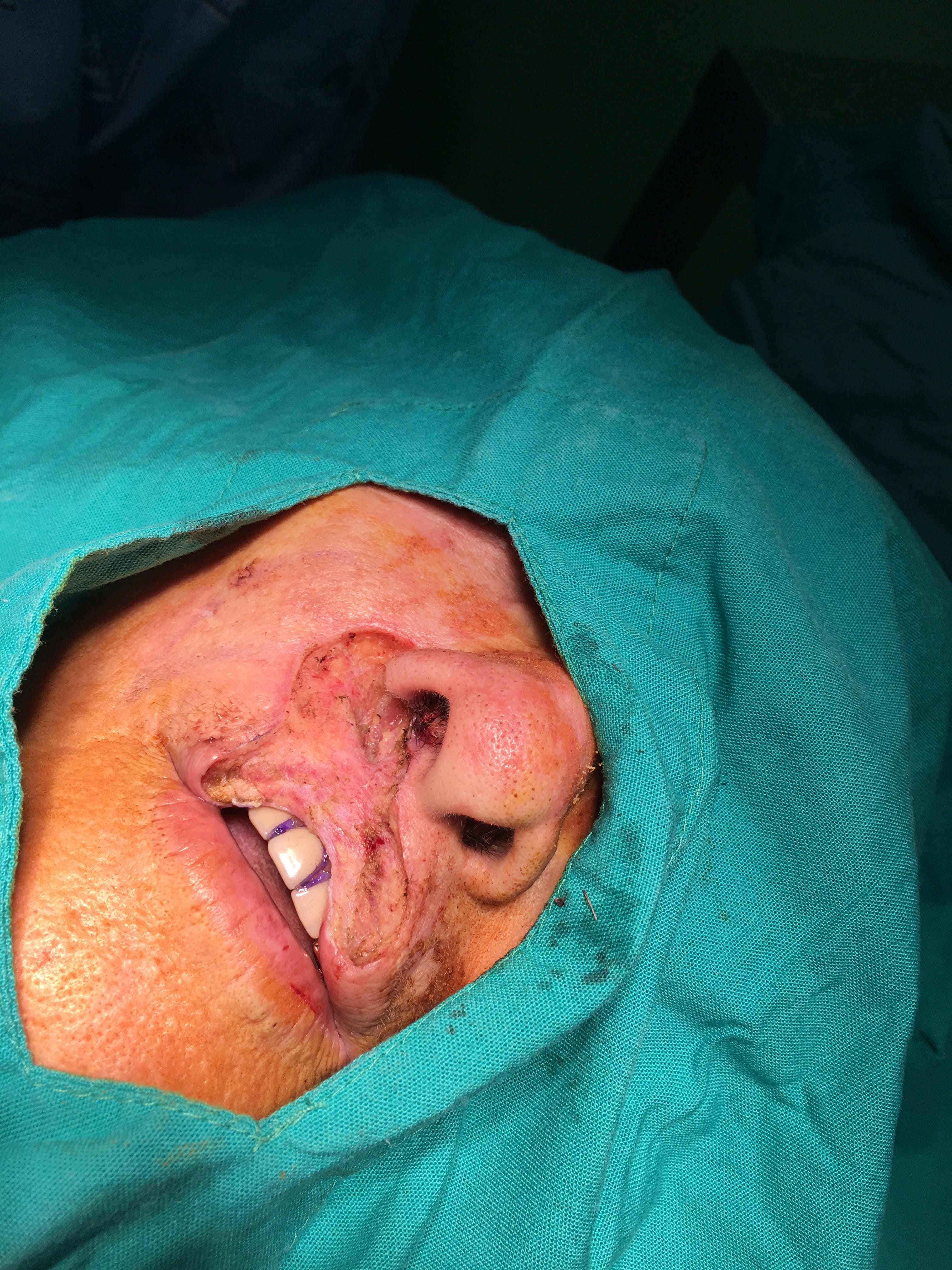 CARCINOMA BASOCELULAR del labio