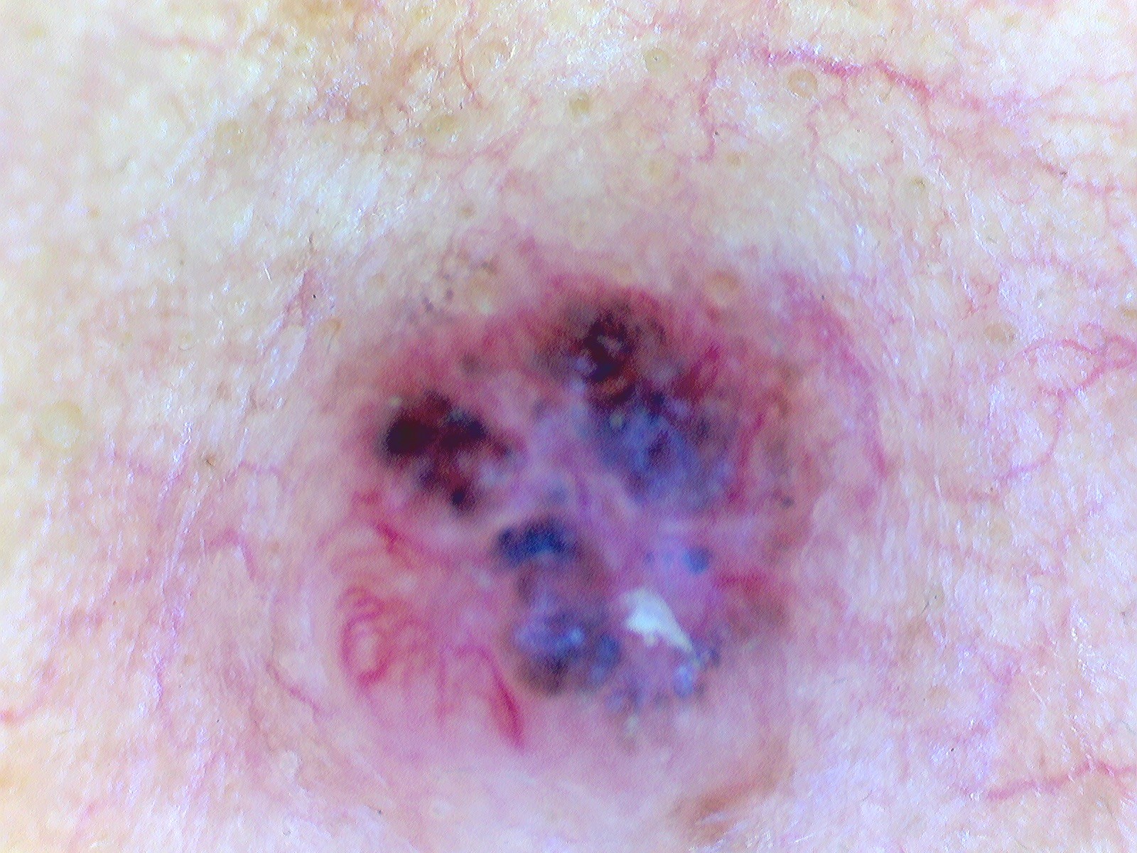 CARCINOMA BASOCELULAR Dermatoscopia
