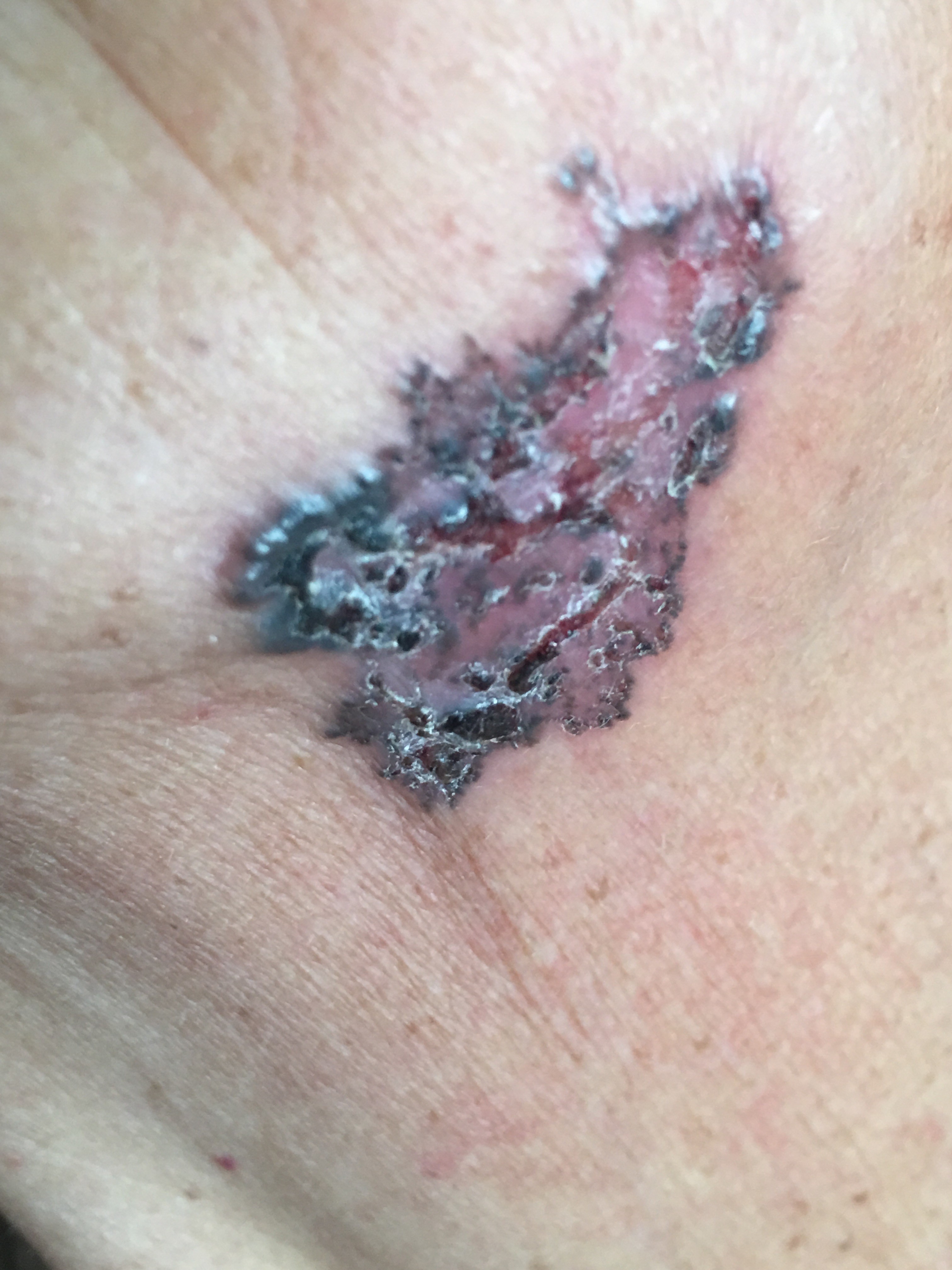 CARCINOMA BASOCELULAR Submandibular