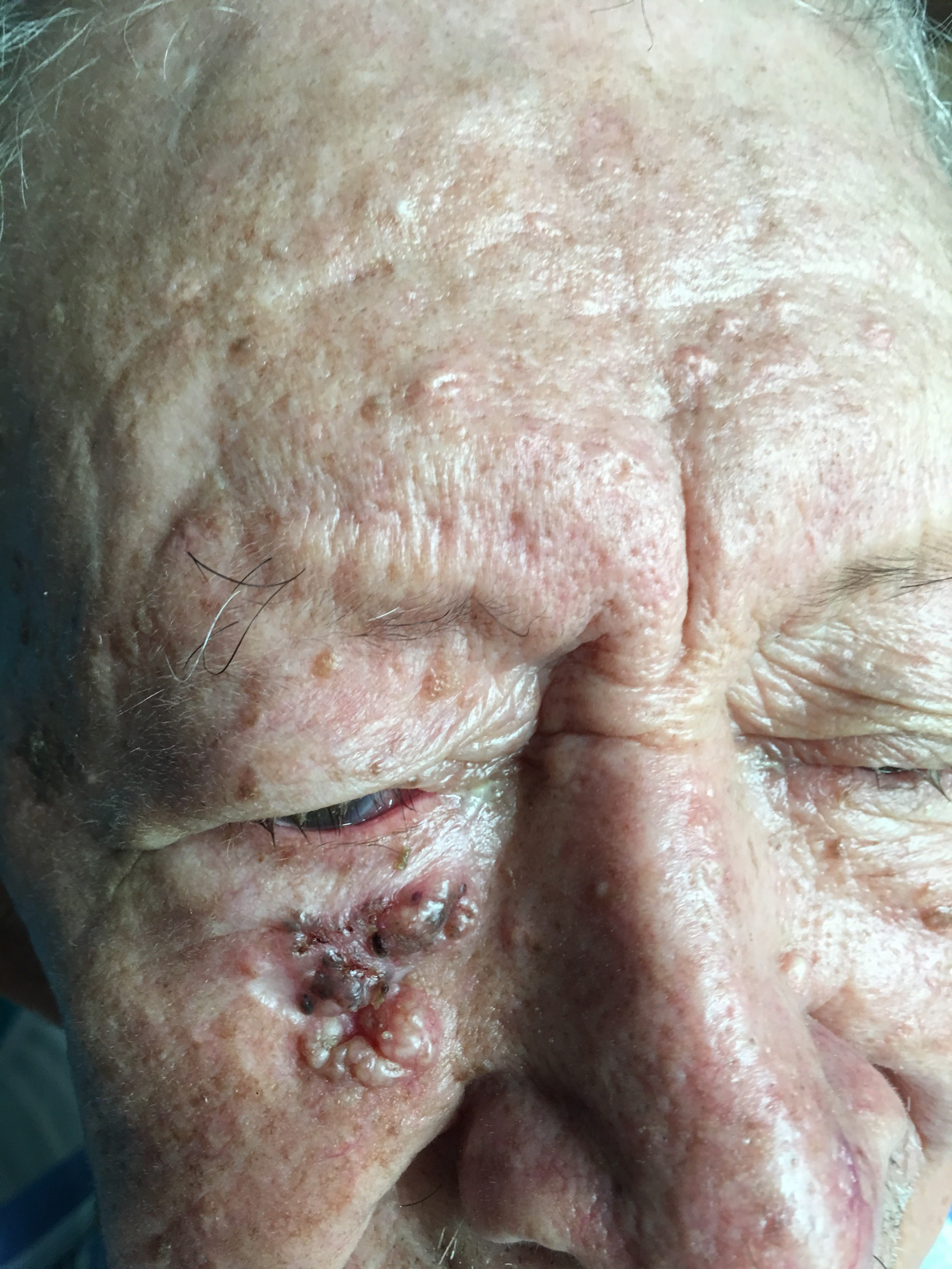 CARCINOMA BASOCELULAR mejilla