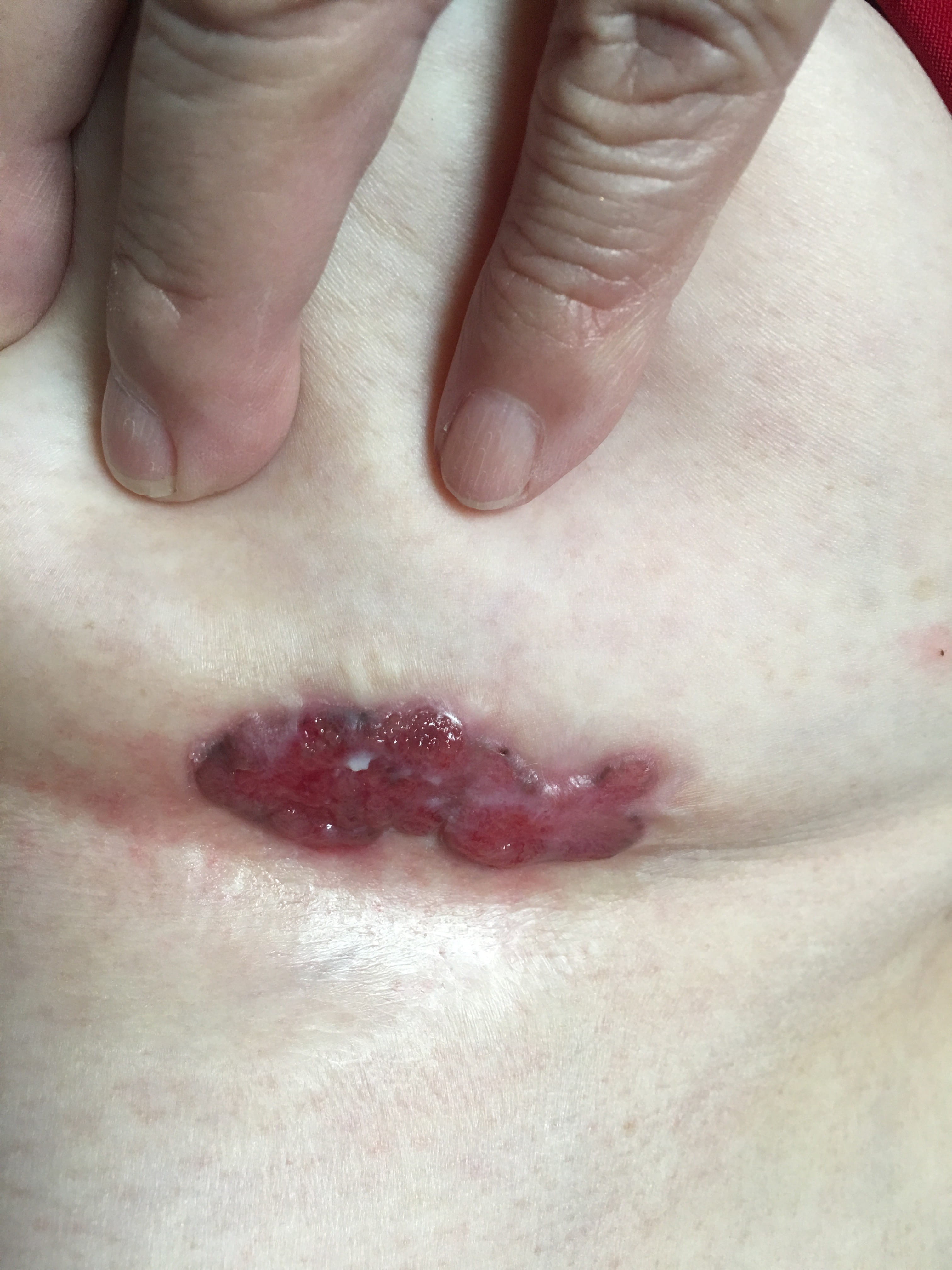 CARCINOMA BASOCELULAR submamario