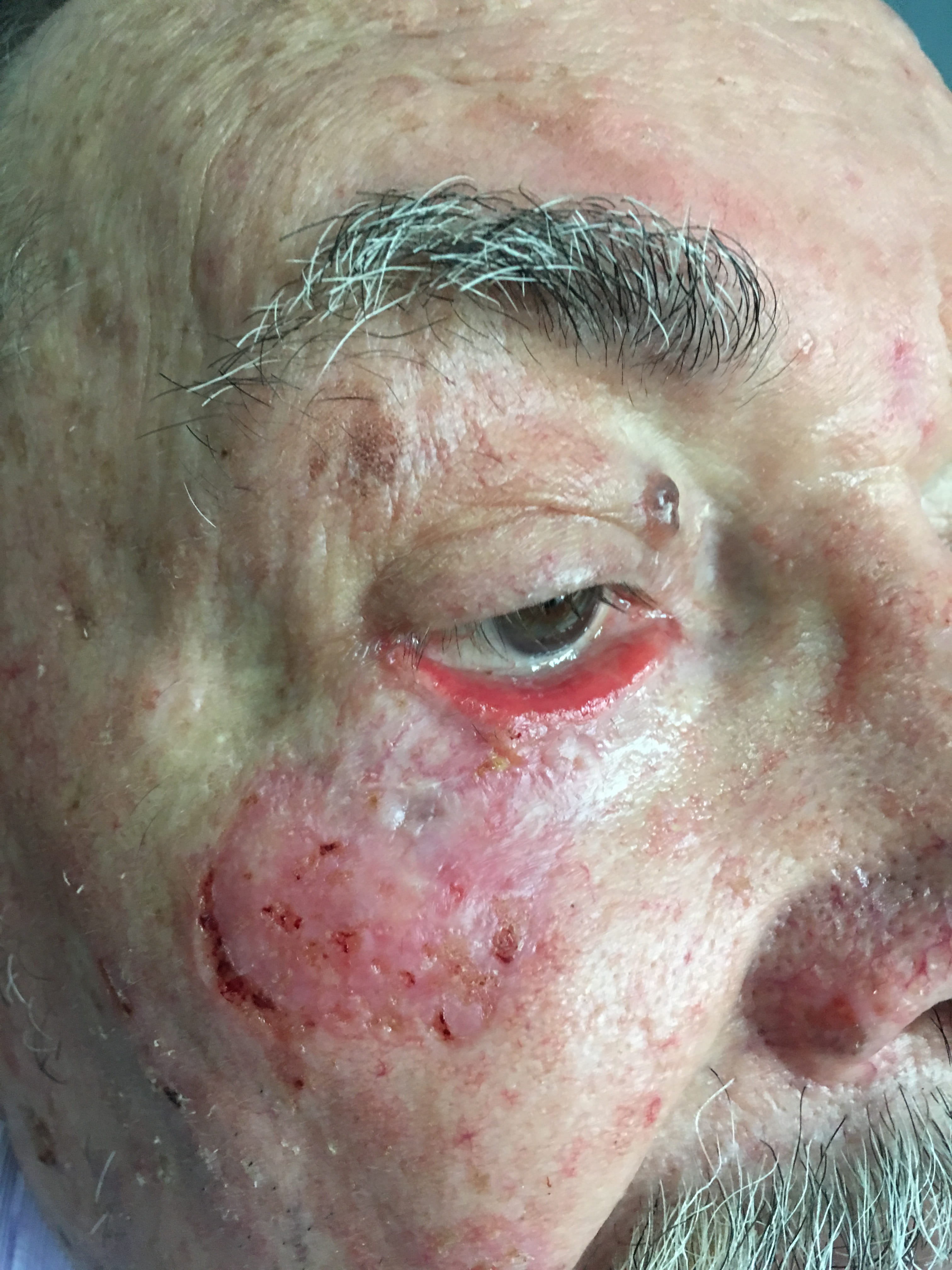 CARCINOMA BASOCELULAR y ectropión