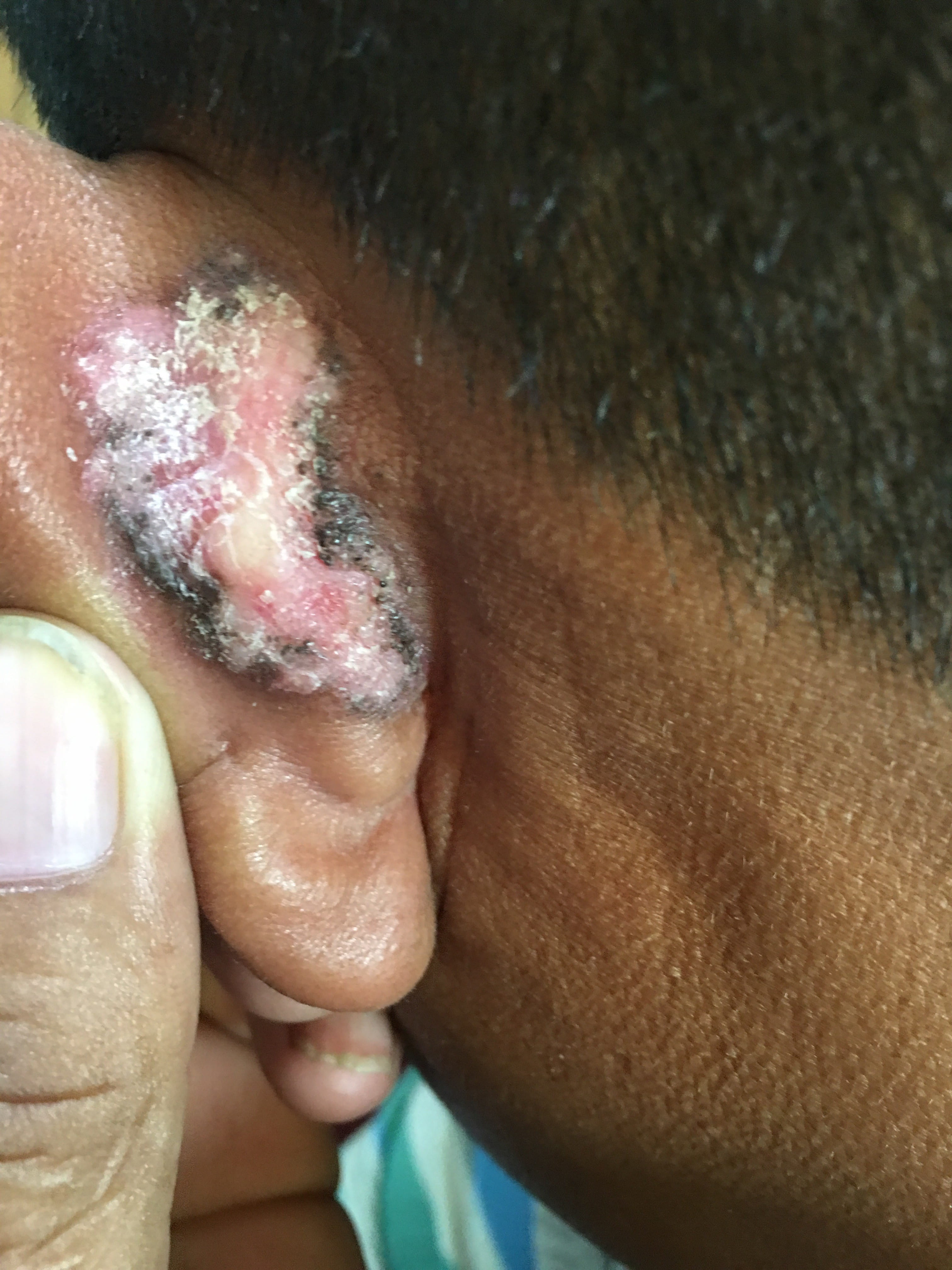 CARCINOMA BASOCELULAR de la oreja