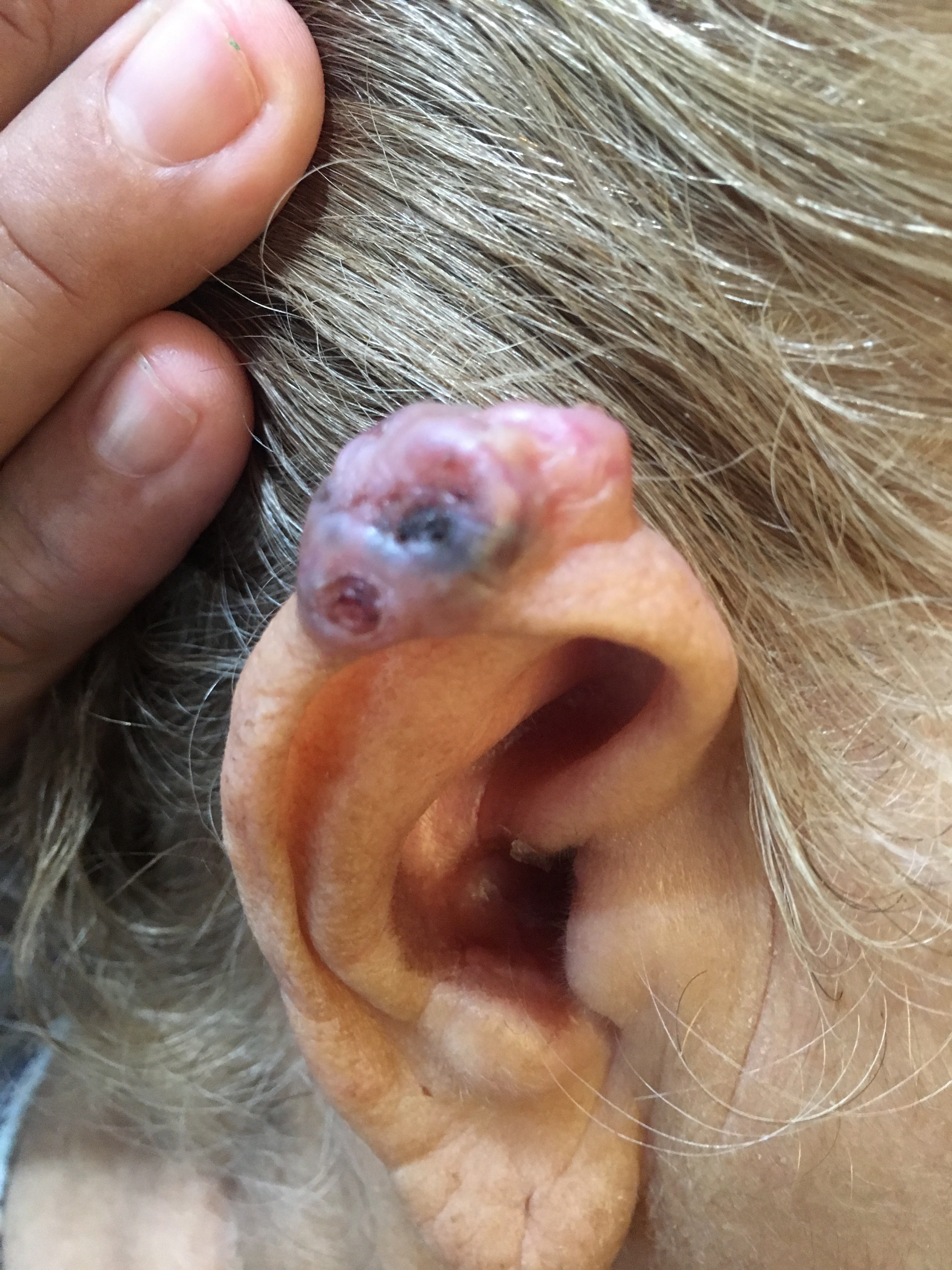 CARCINOMA BASOCELULAR de la oreja
