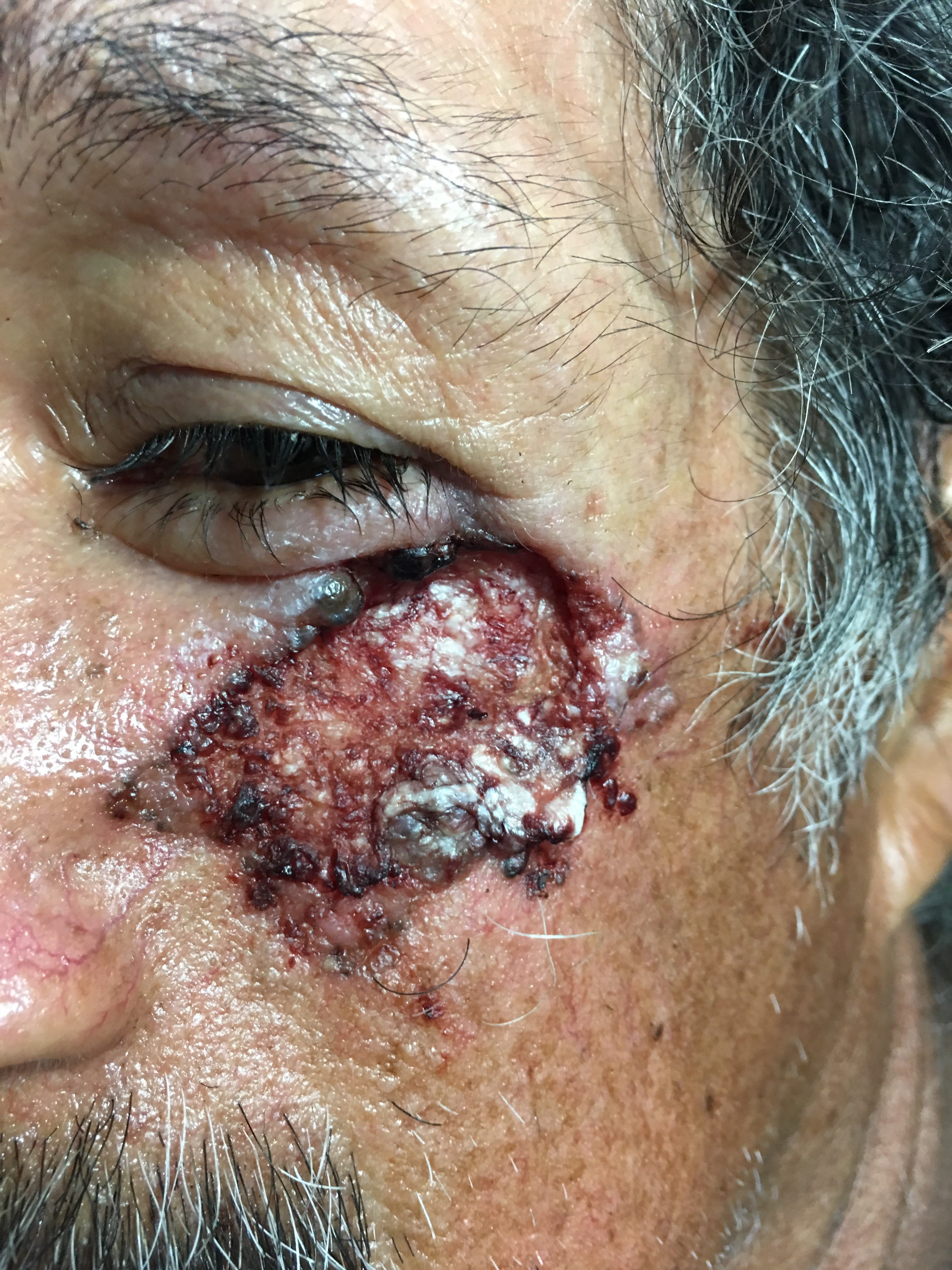 CARCINOMA BASOCELULAR ulcerado