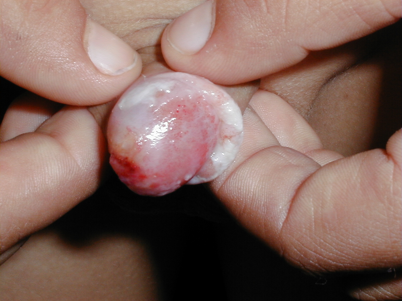 CANDIDOSIS PENE
