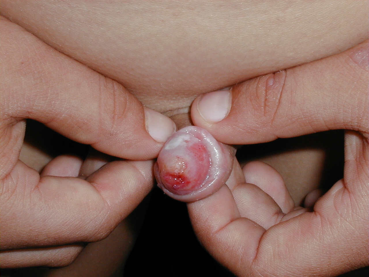 CANDIDOSIS PENE