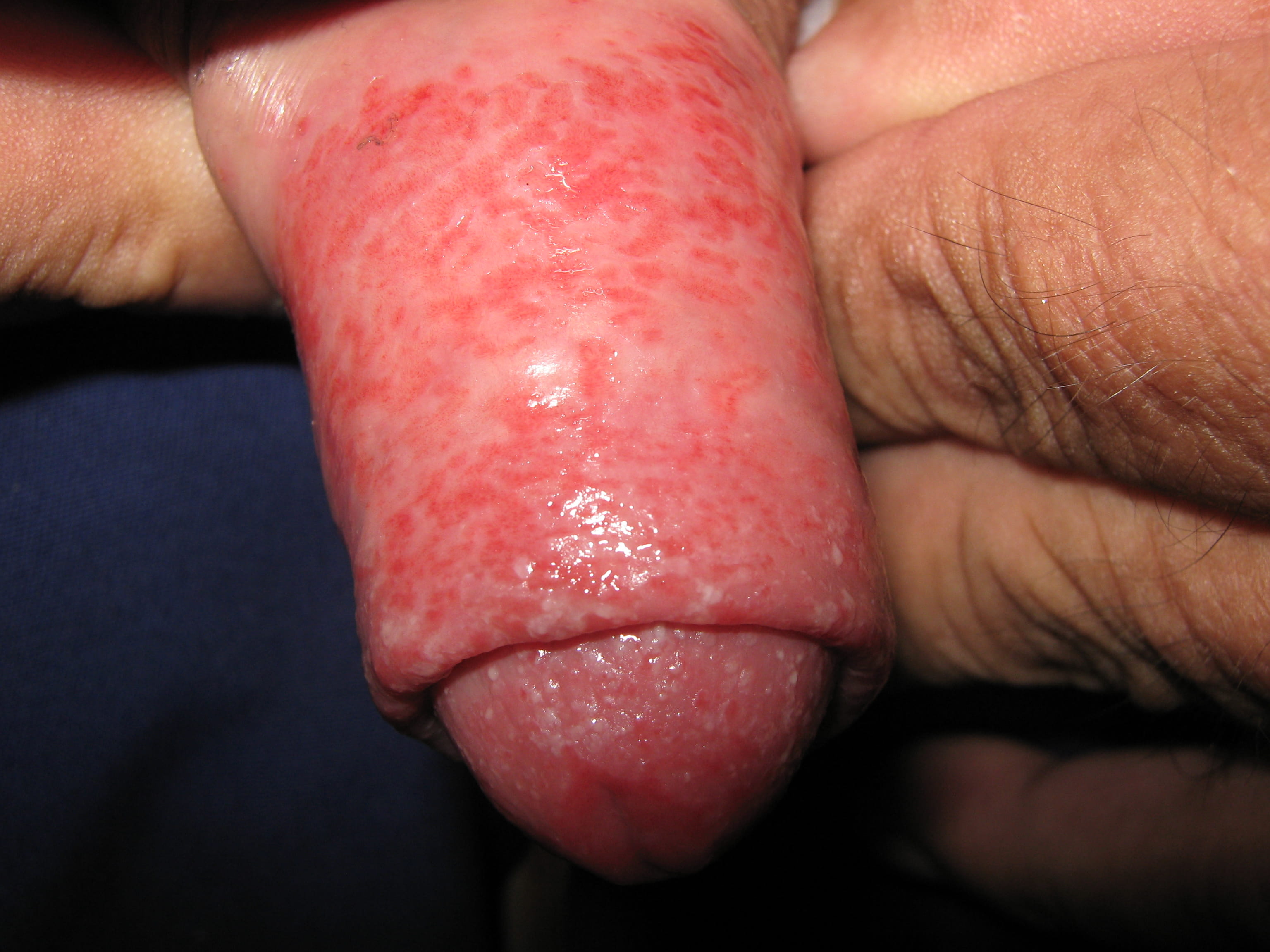 CANDIDOSIS en pene