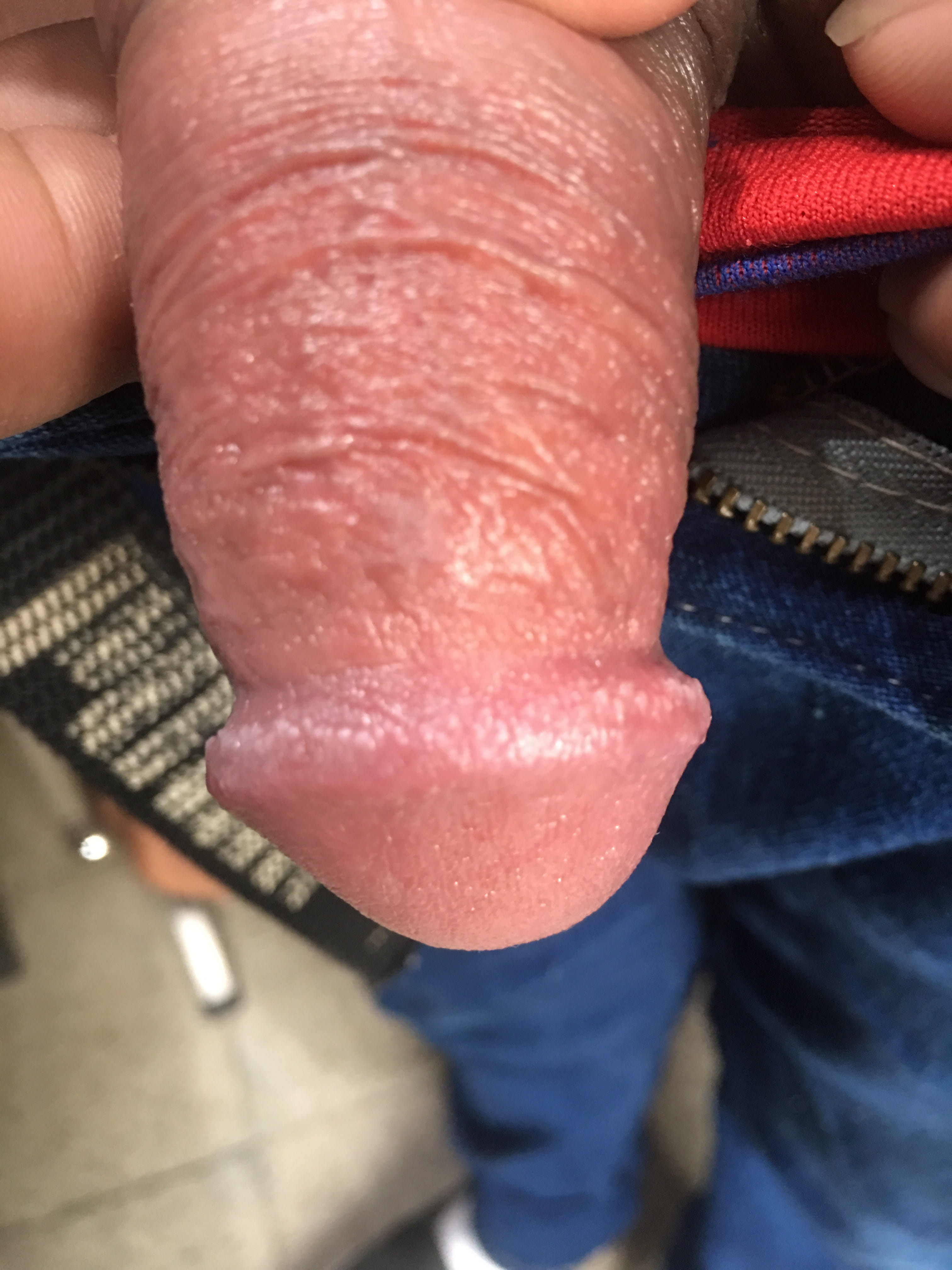 CANDIDOSIS en pene