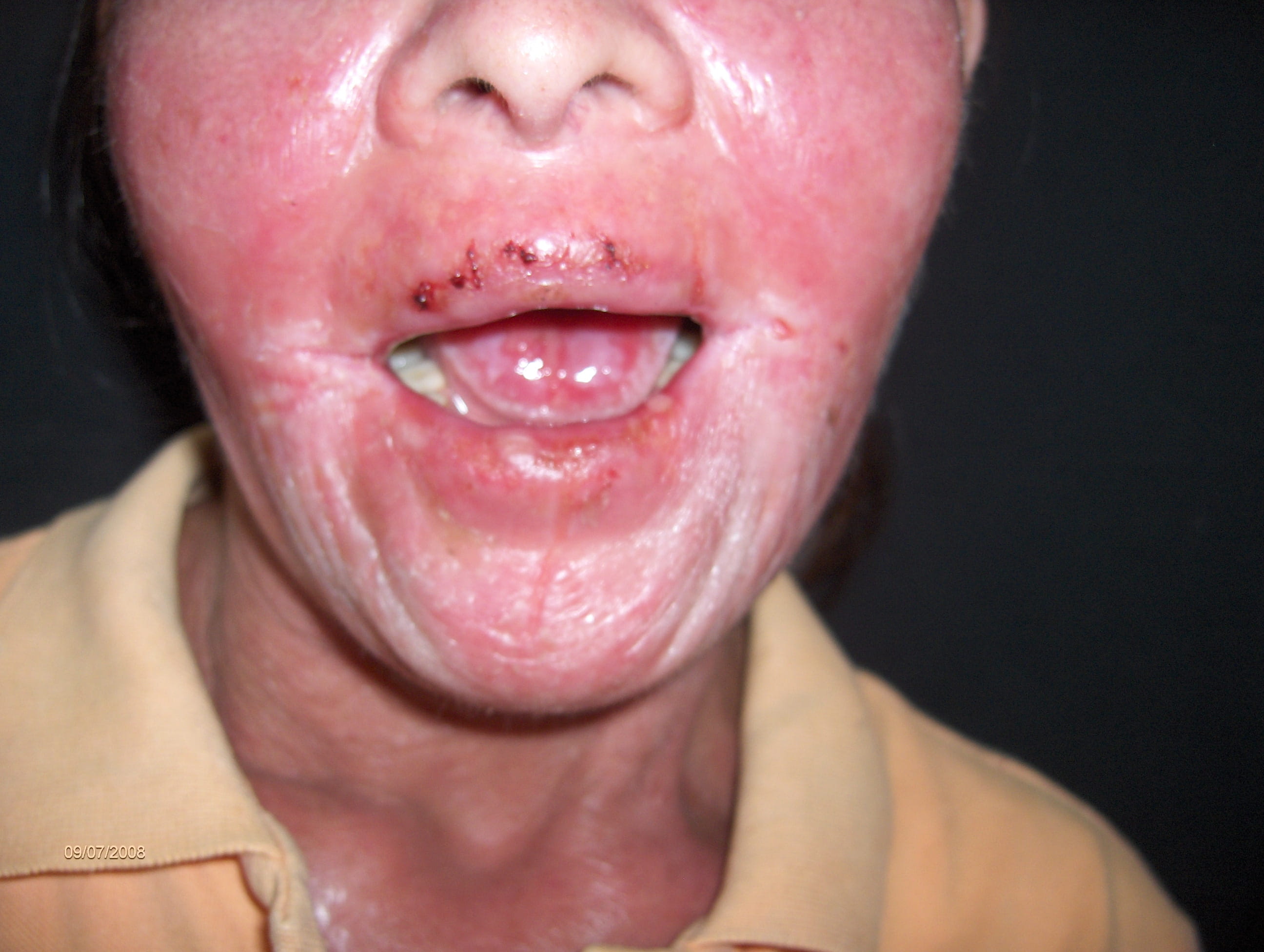 CANDIDOSIS mucocutanea cronica