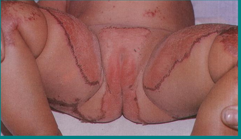 ACRODERMATITIS ENTEROPATICA