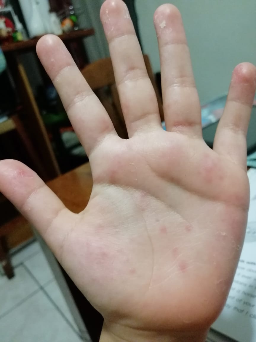 VESICULAS Y PUSTULAS EN MANOS