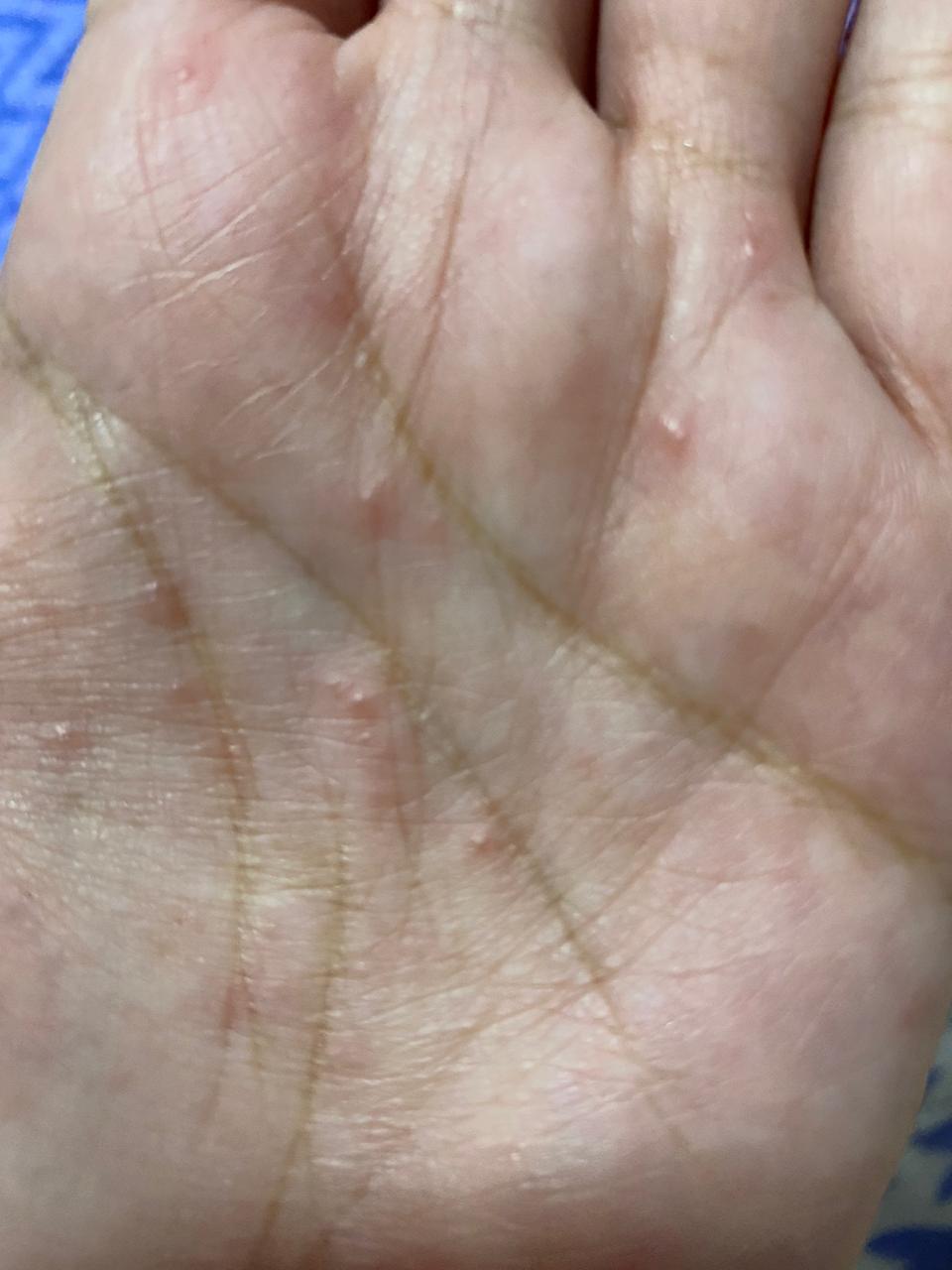 VESICULAS Y PUSTULAS EN MANOS