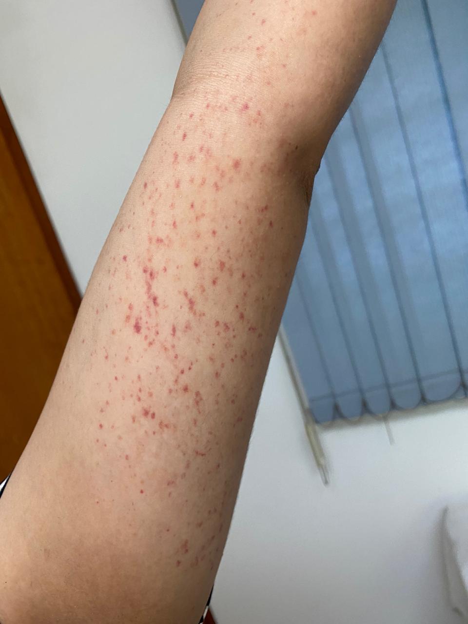 VASCULITIS