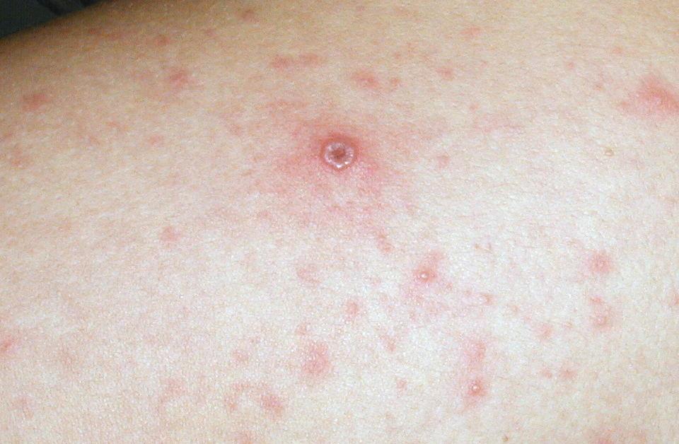 VARICELA