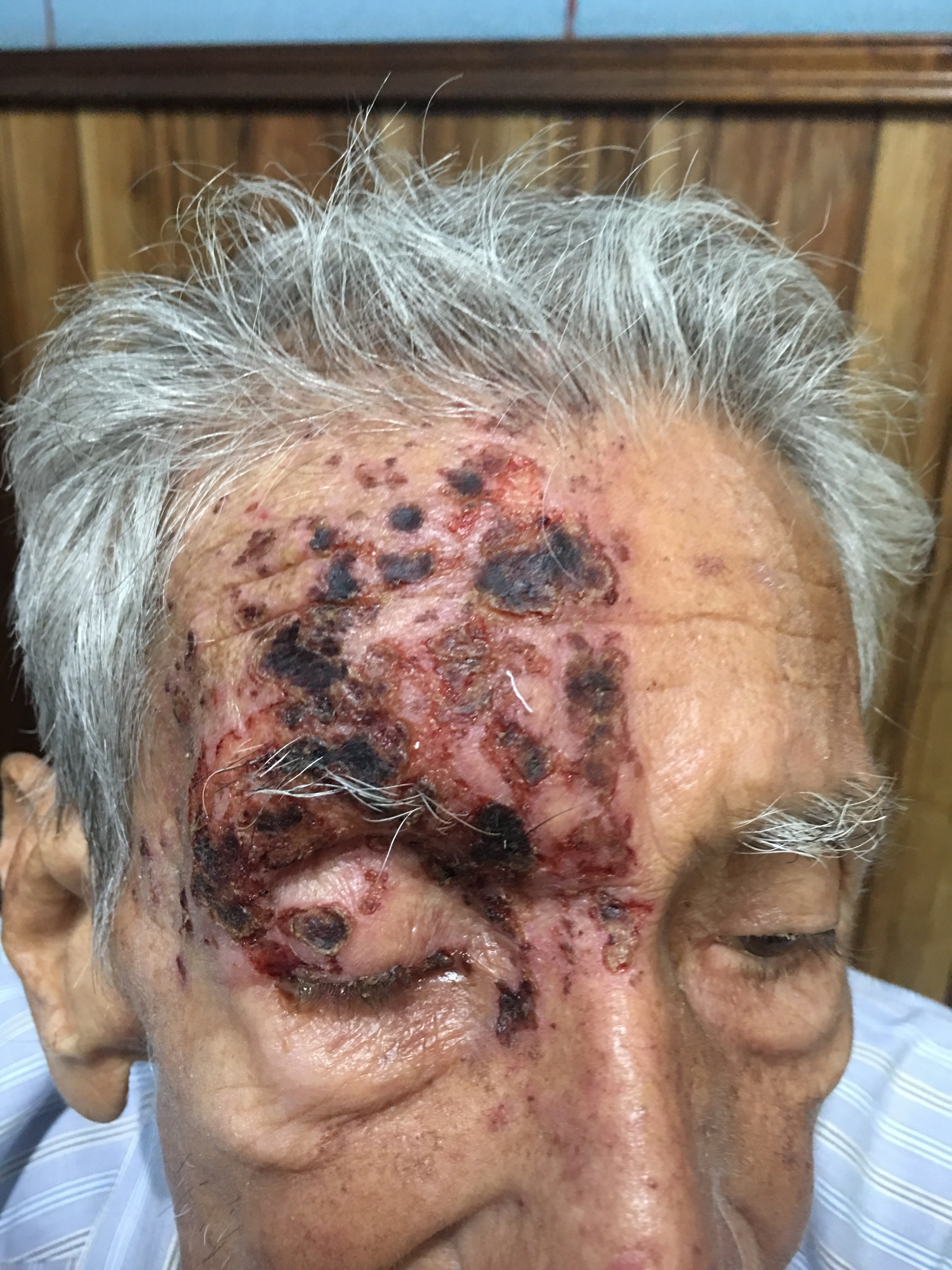 HERPES ZOSTER FACIAL