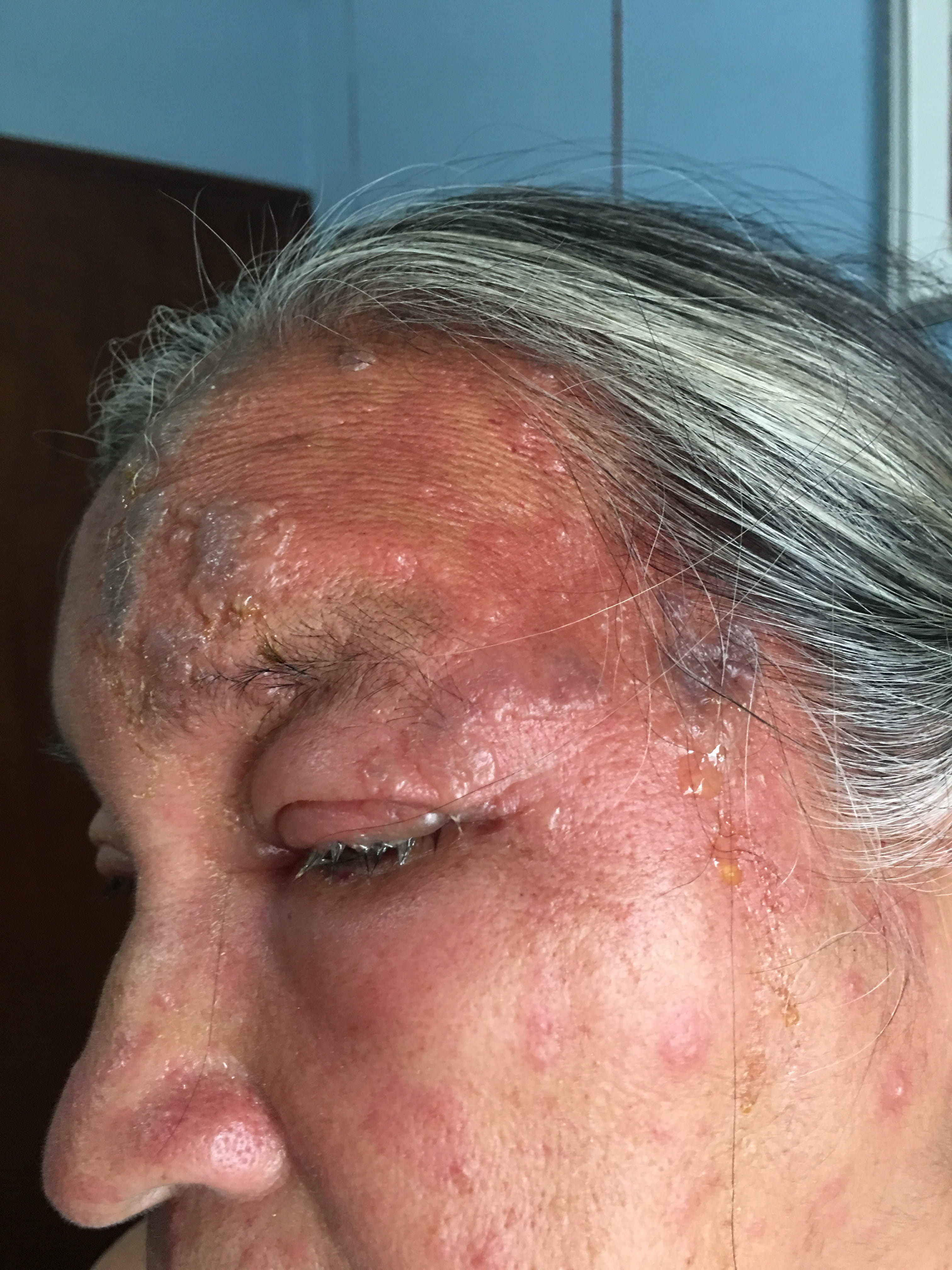 HERPES ZOSTER FACIAL