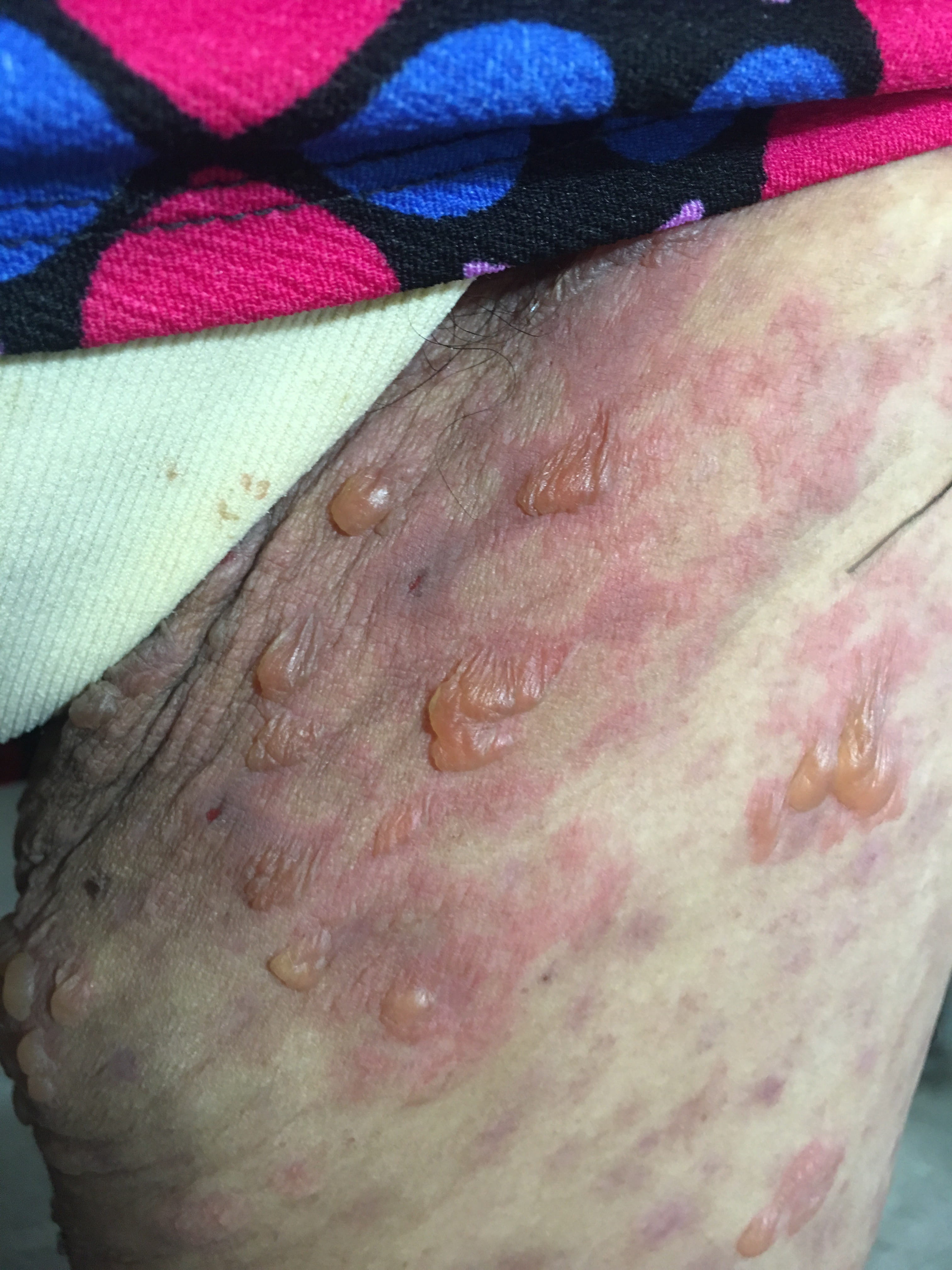 PENFIGOIDE AMPOLLOSO