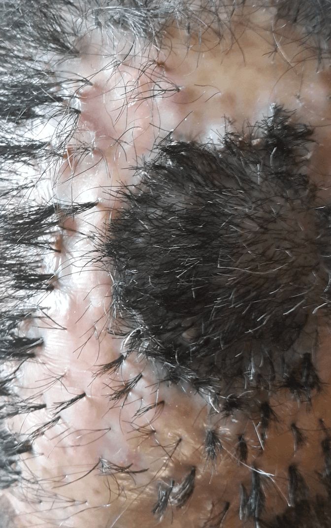 FOLICULITIS DECALVANTE  Politriquia