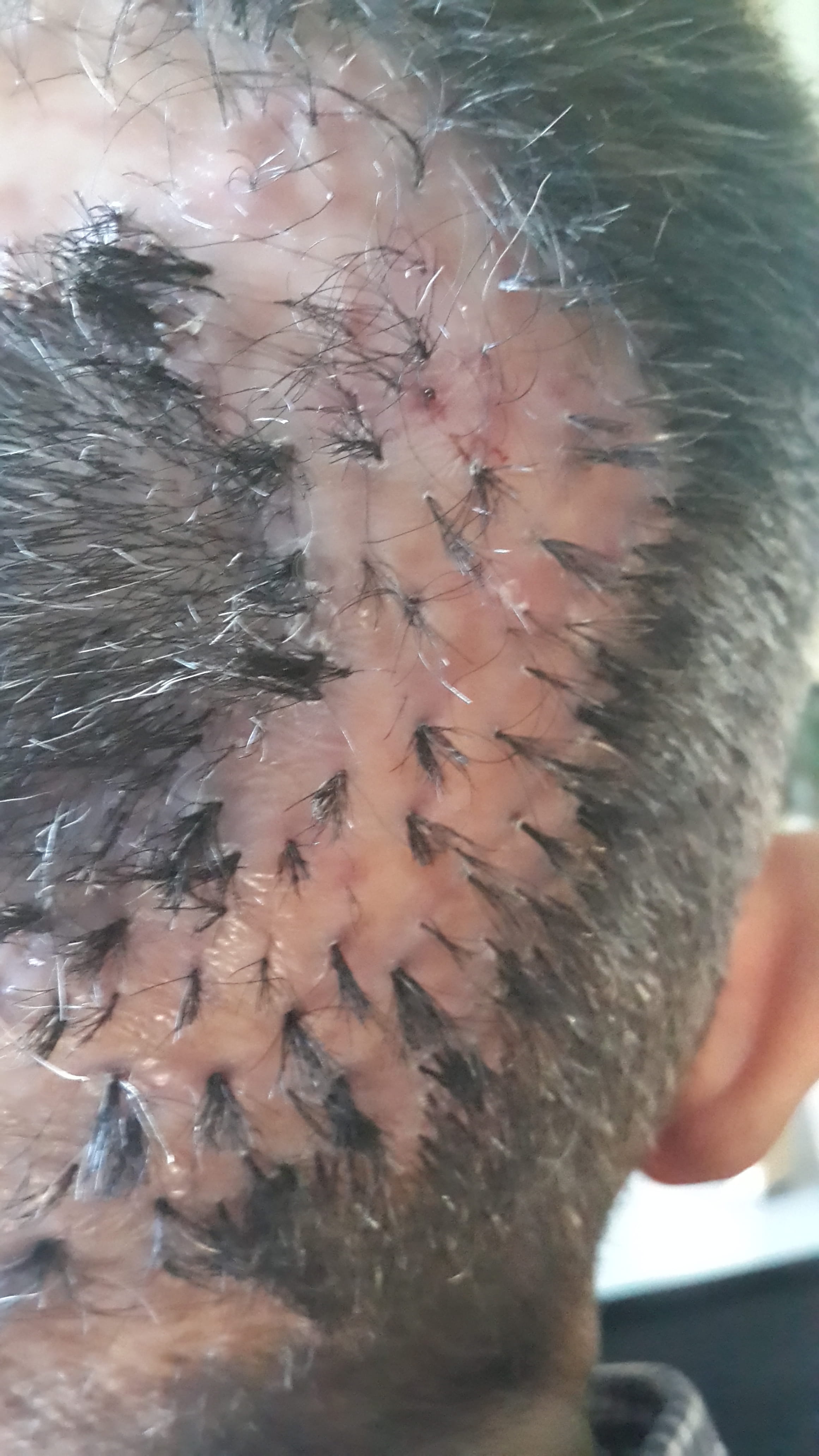 FOLICULITIS DECALVANTE  Politriquia
