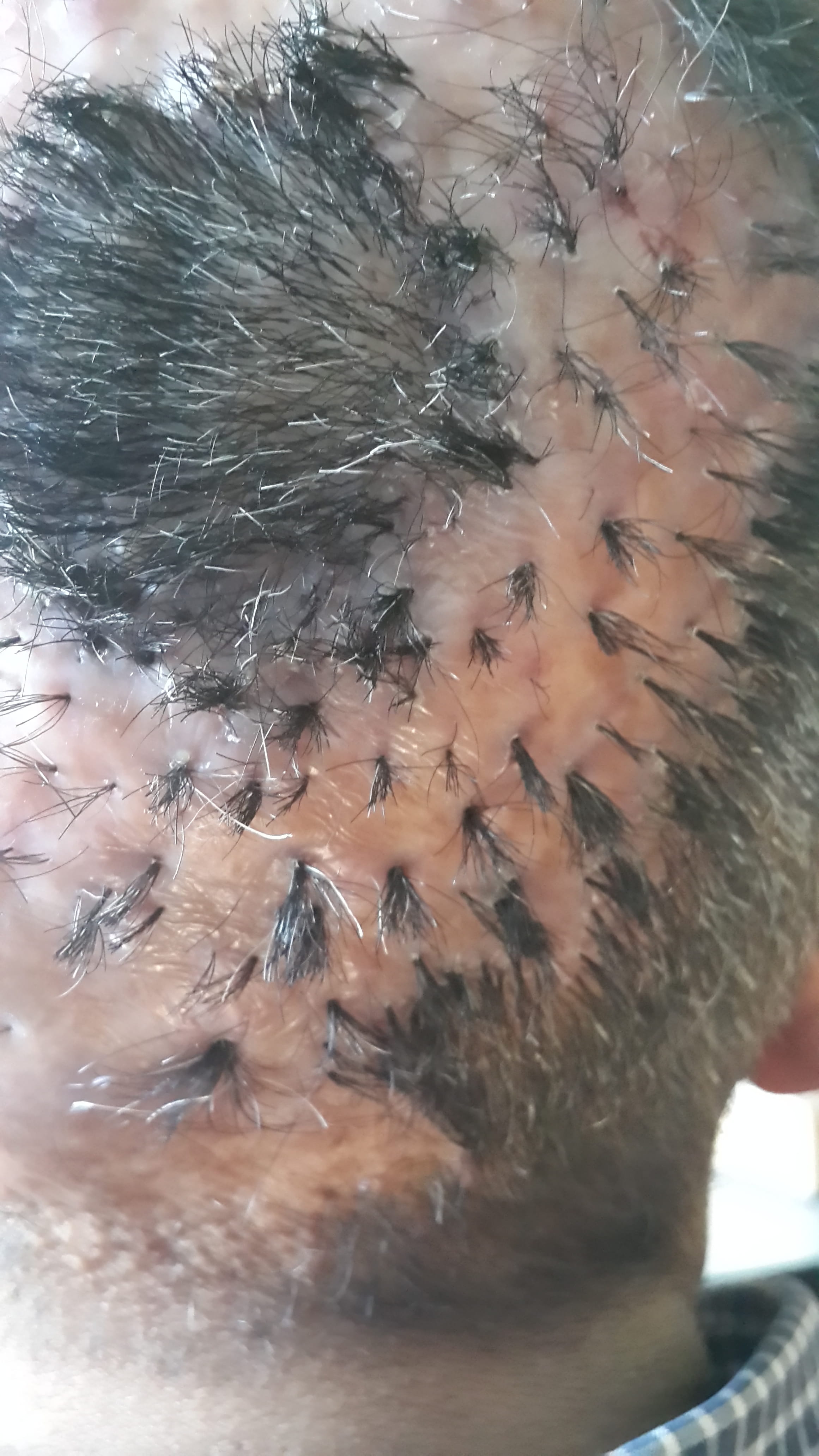 FOLICULITIS DECALVANTE  Politriquia