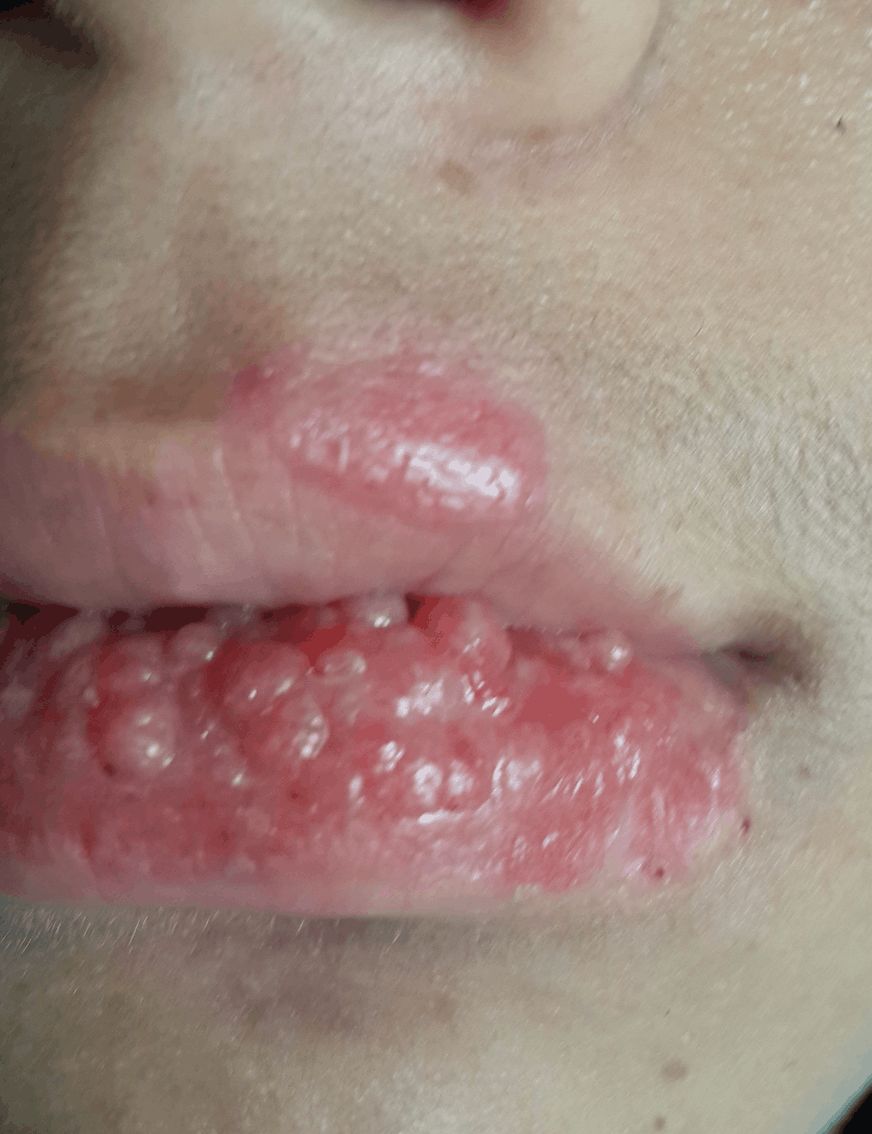 QUEILITIS GLANDULAR