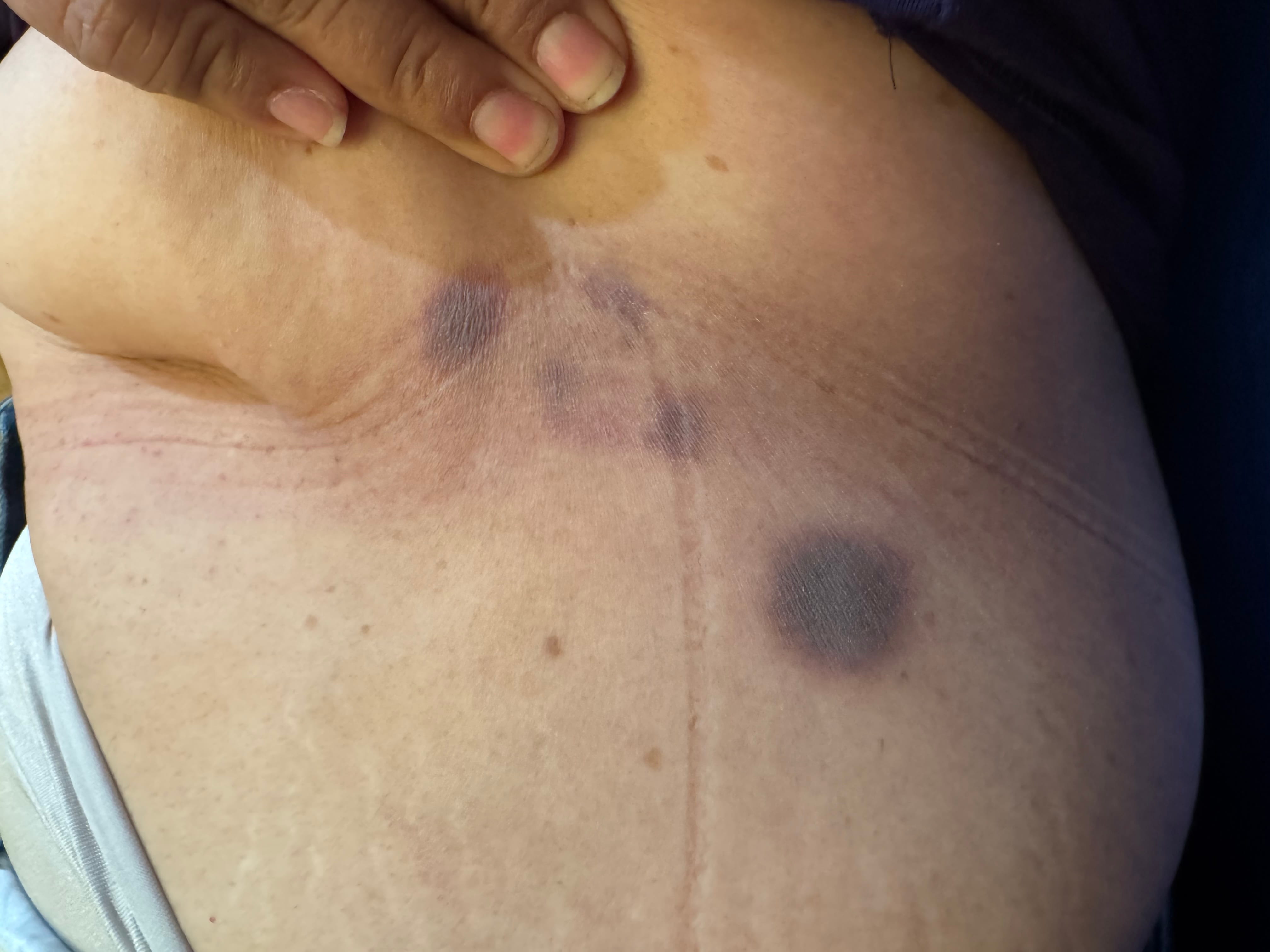 ERIREMA PIGMENTADO FIJO por Naproxeno