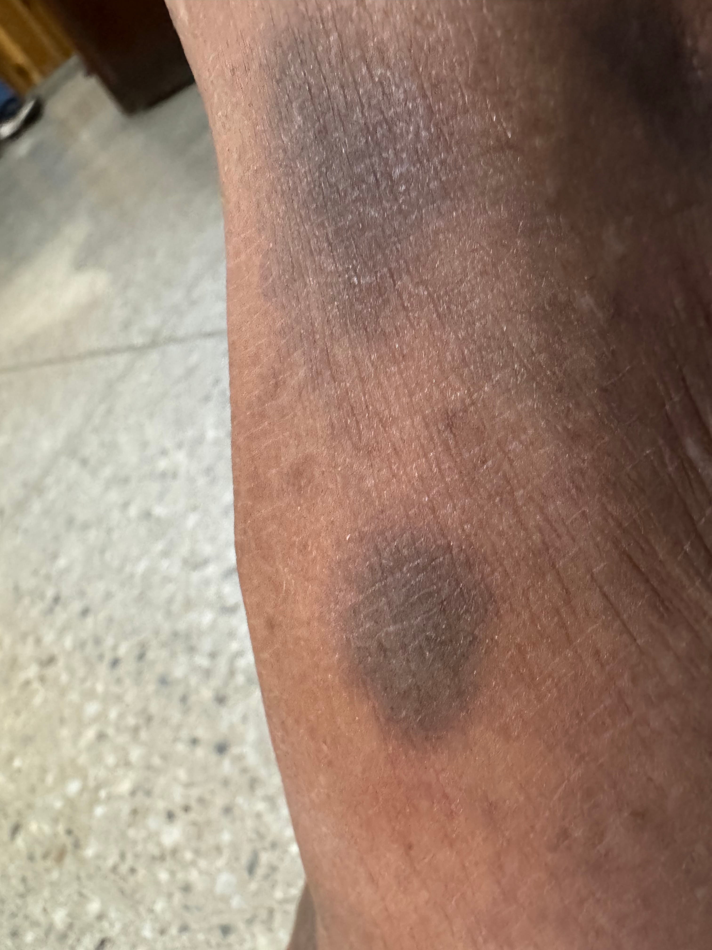 ERIREMA PIGMENTADO FIJO por Naproxeno