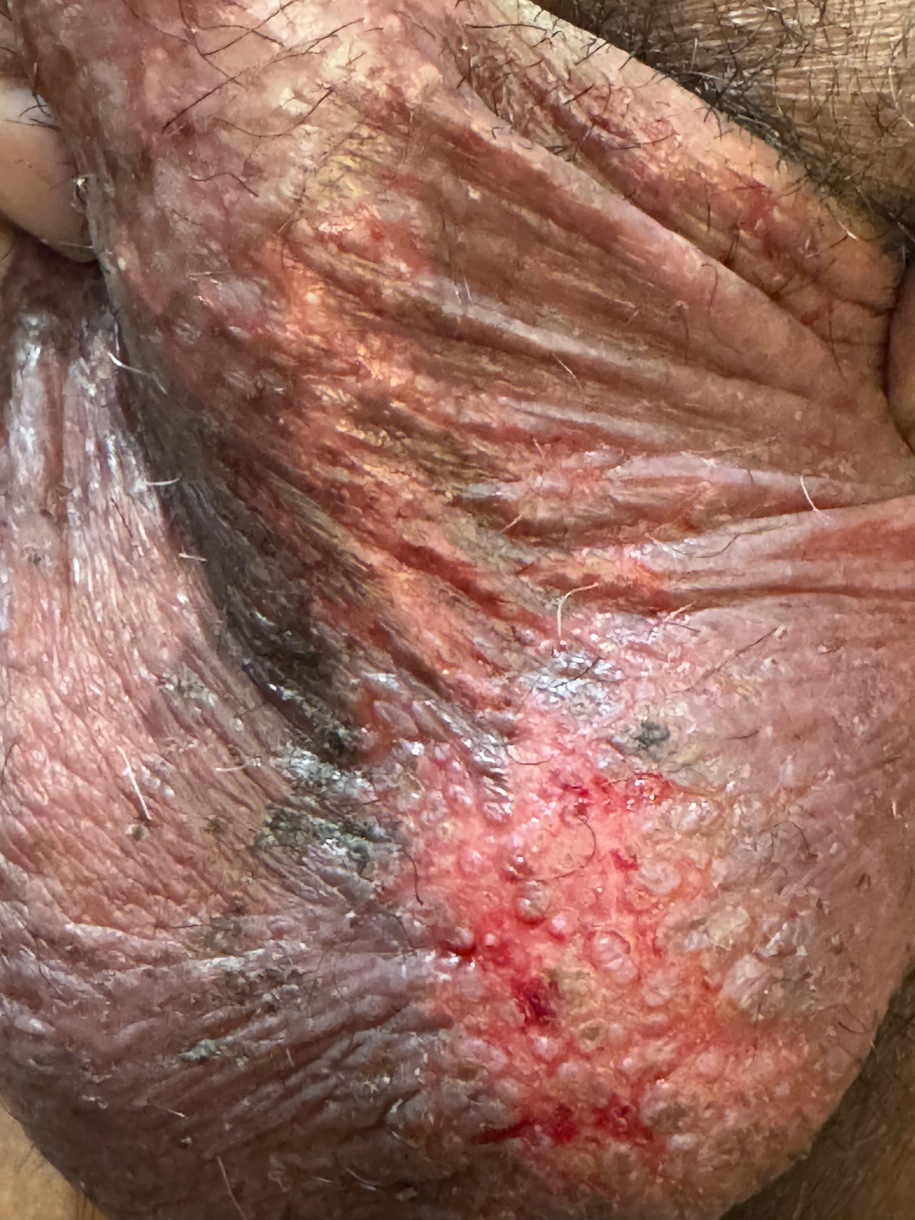 DERMATITIS POR CONTACTO - Emplasto de plantas medicinales caseras