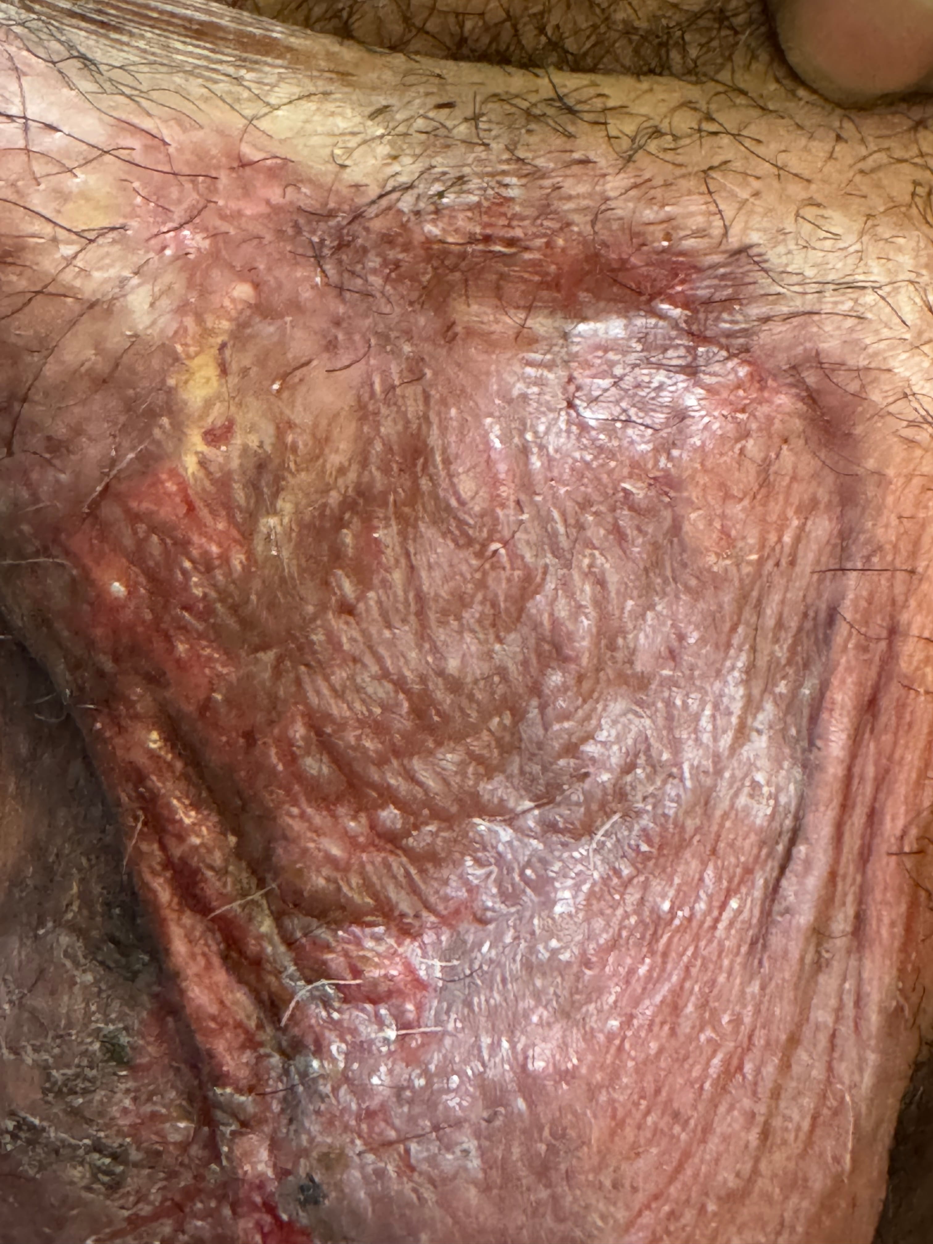 DERMATITIS POR CONTACTO - Emplasto de plantas medicinales caseras