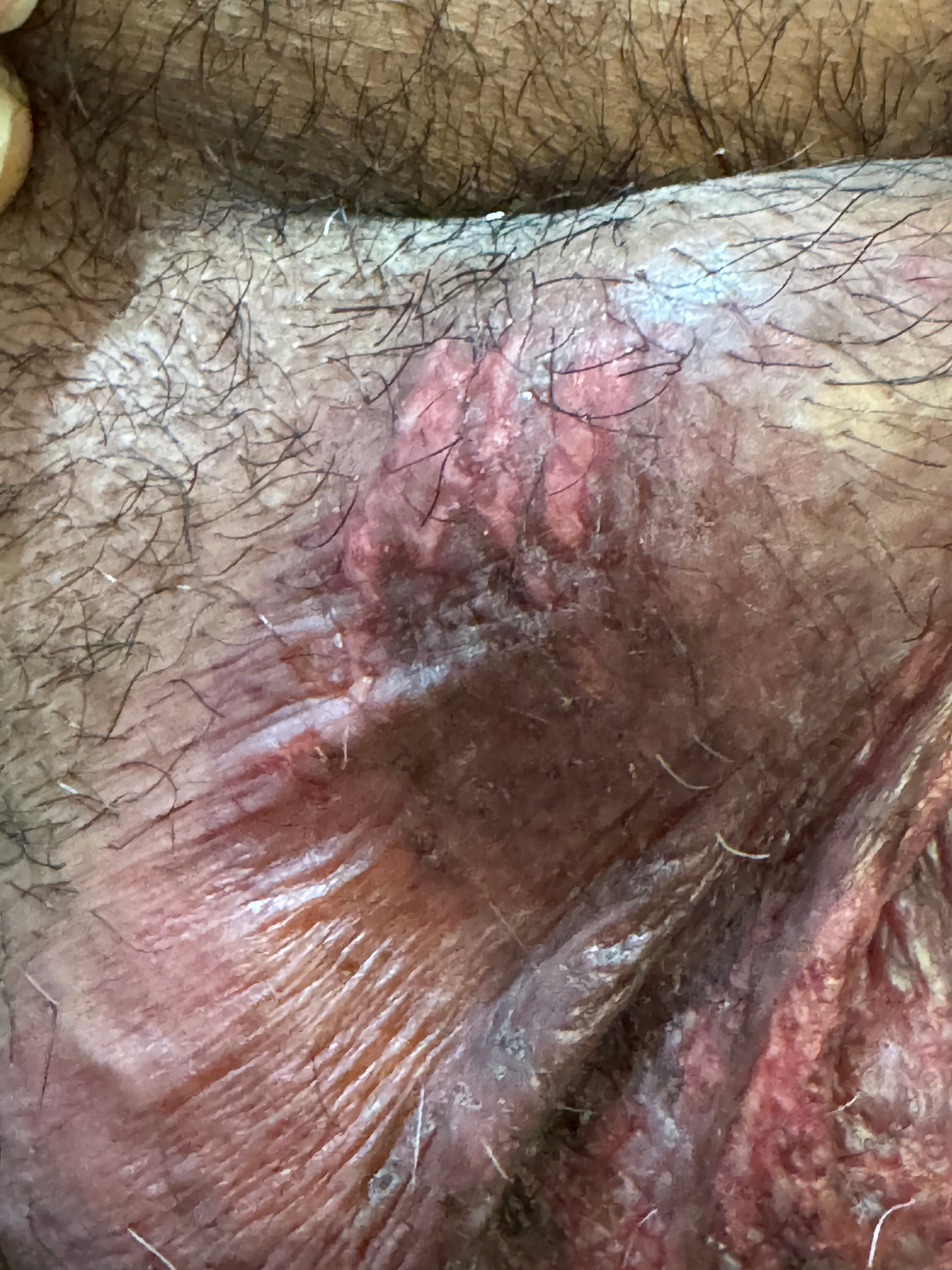 DERMATITIS POR CONTACTO - Emplasto de plantas medicinales caseras