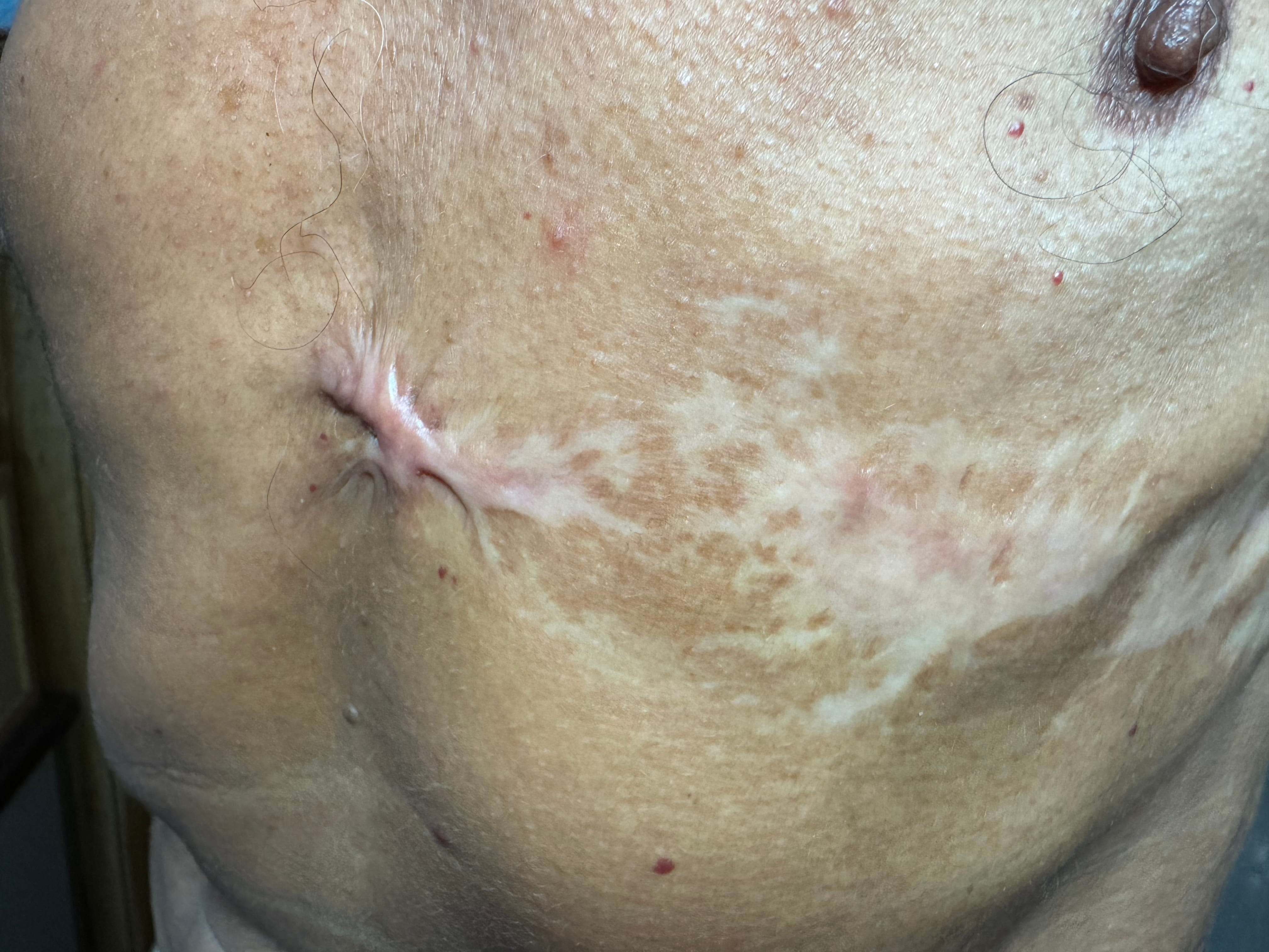 CICATRIZ Post Herpes Zoster Intercostal