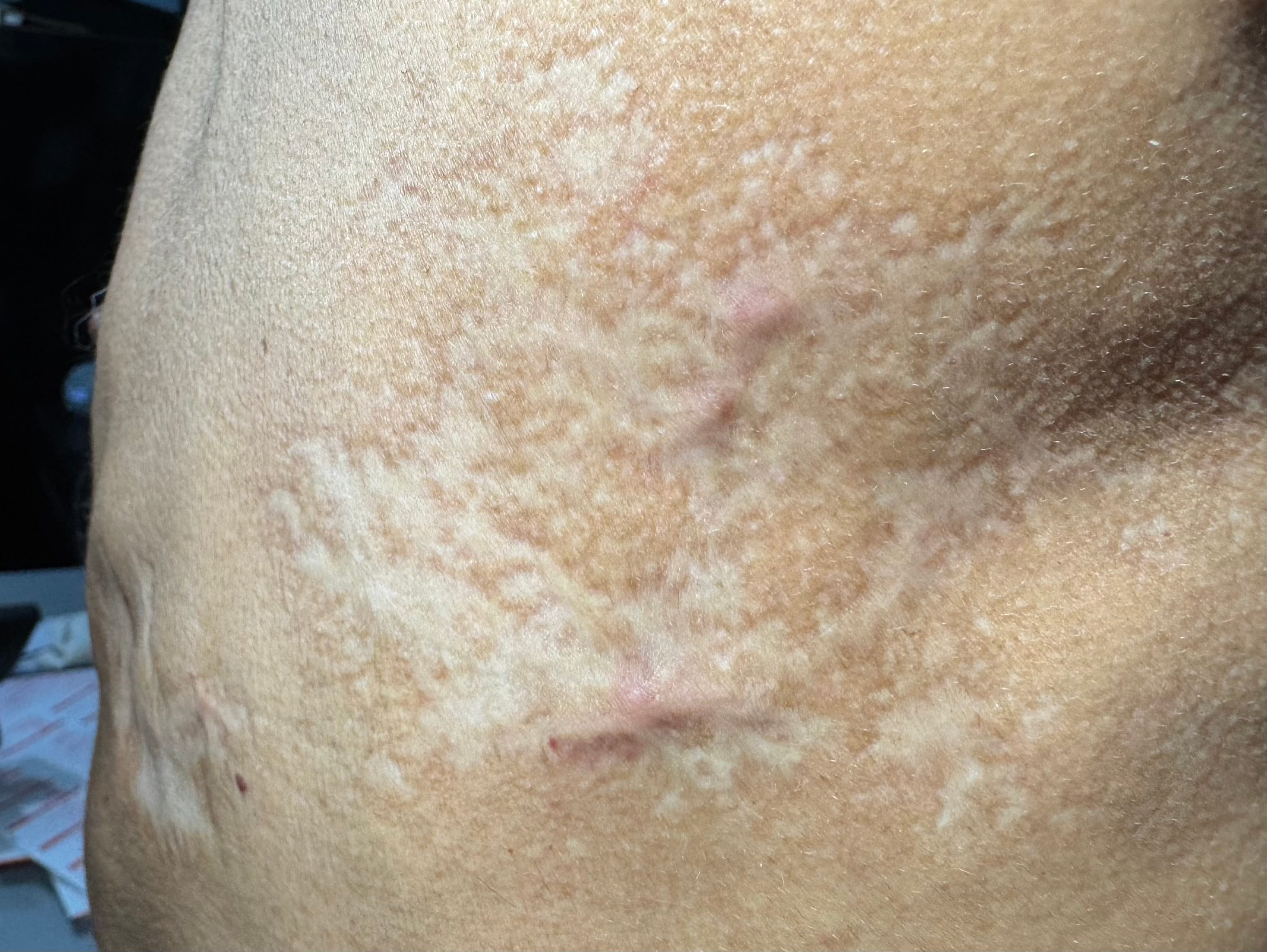 CICATRIZ Post Herpes Zoster Intercostal