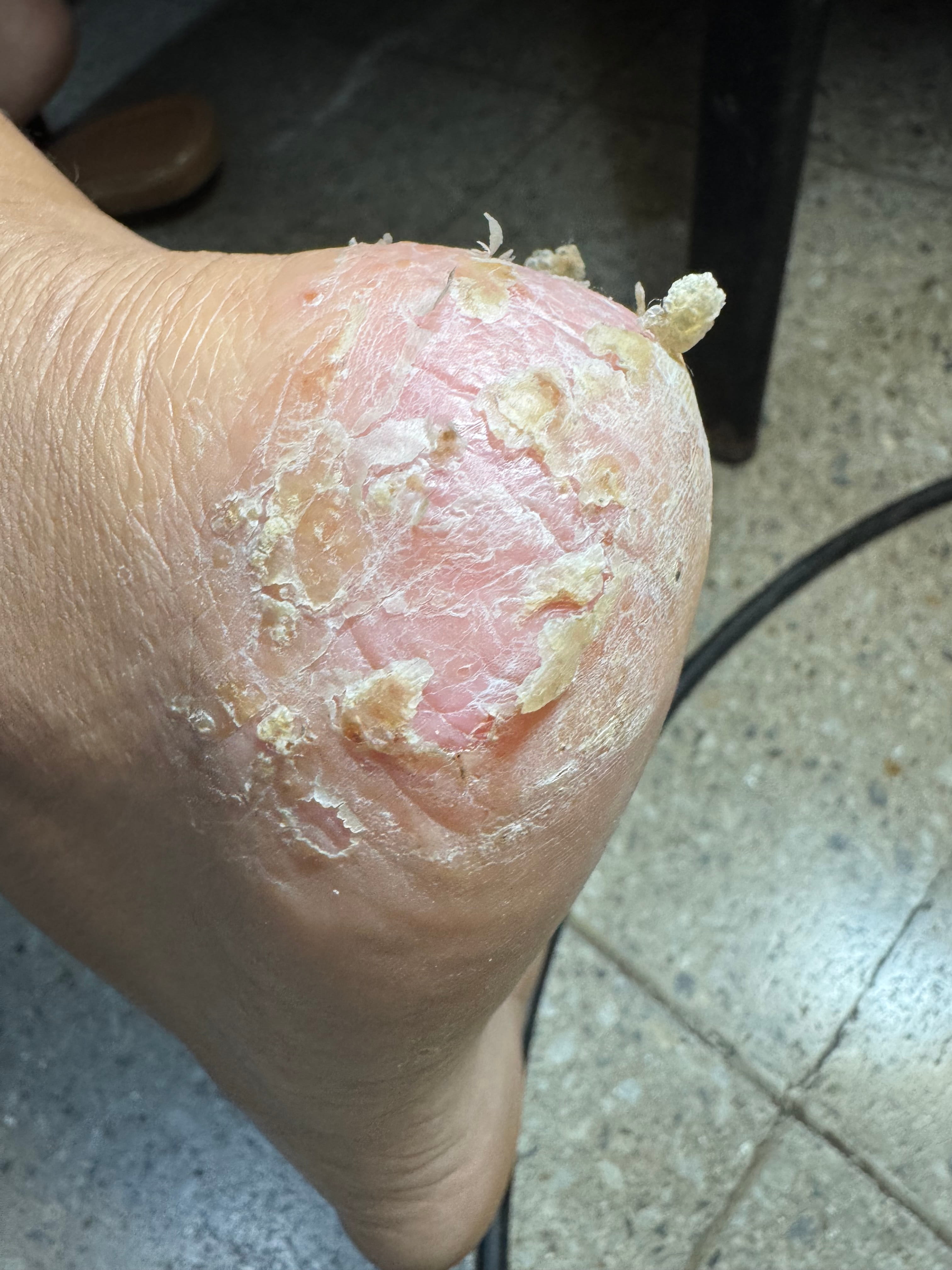 DERMATITIS CRONICA - Rasurado de tilosis + Lociones antimicóticas