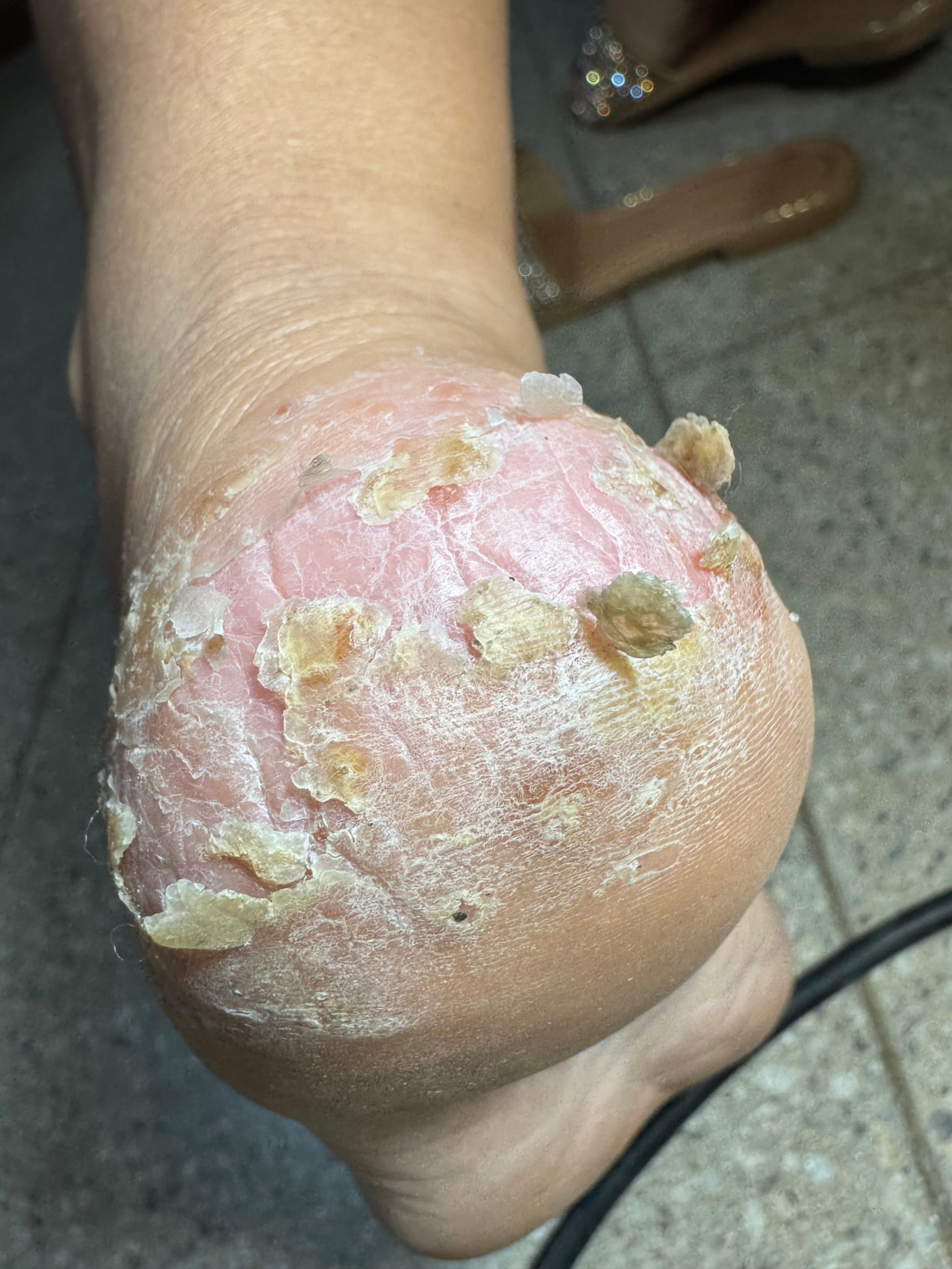 DERMATITIS CRONICA - Rasurado de tilosis + Lociones antimicóticas