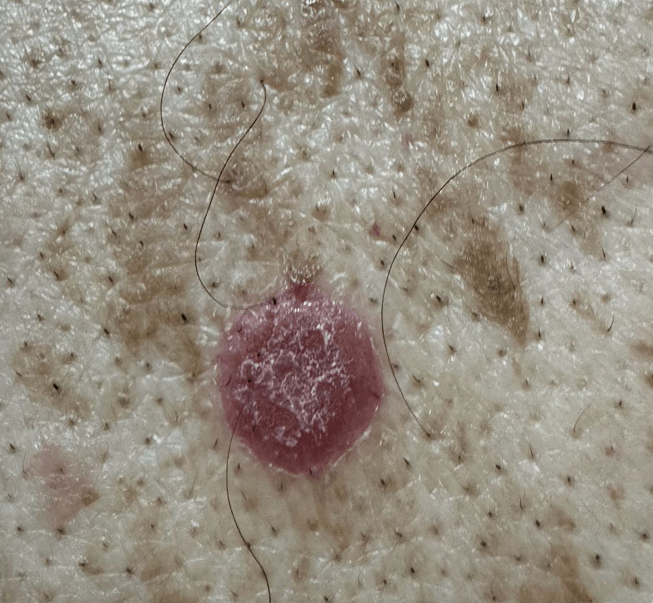 QUERATOSIS SEBORREICA y Psoriasis