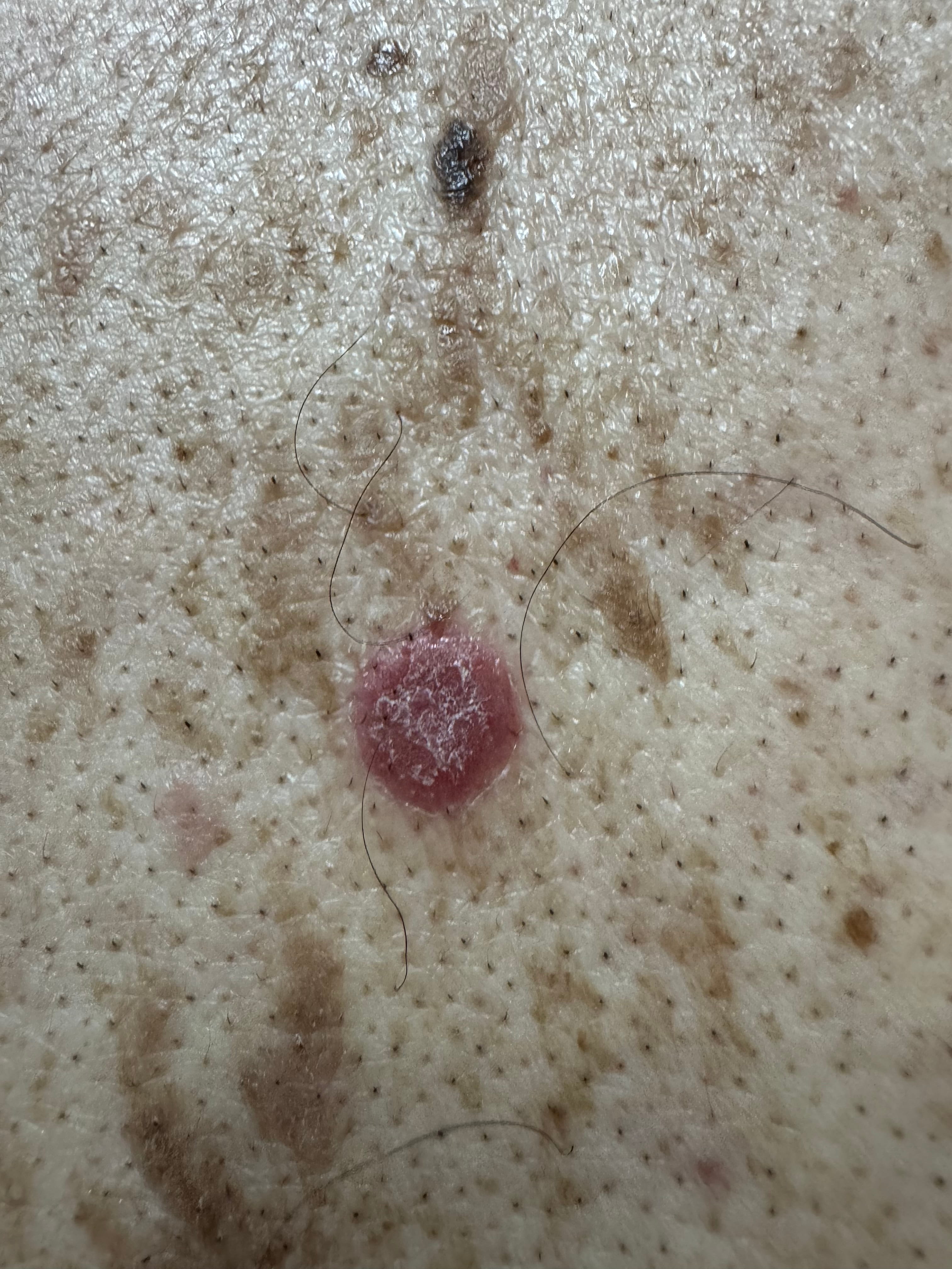 QUERATOSIS SEBORREICA y Psoriasis