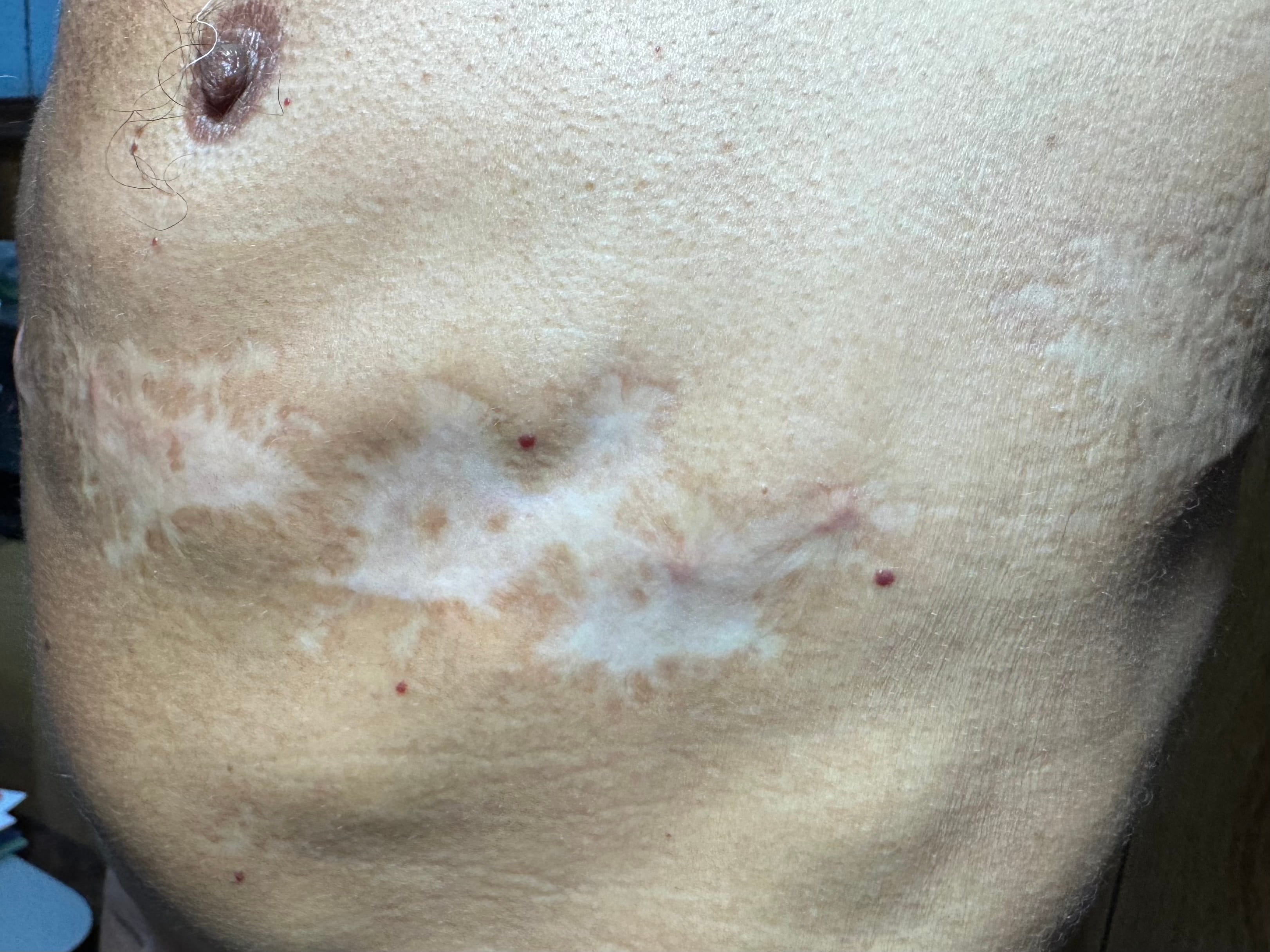 CICATRIZ ACROMICA Y ATROFICA post Herpes Zoster