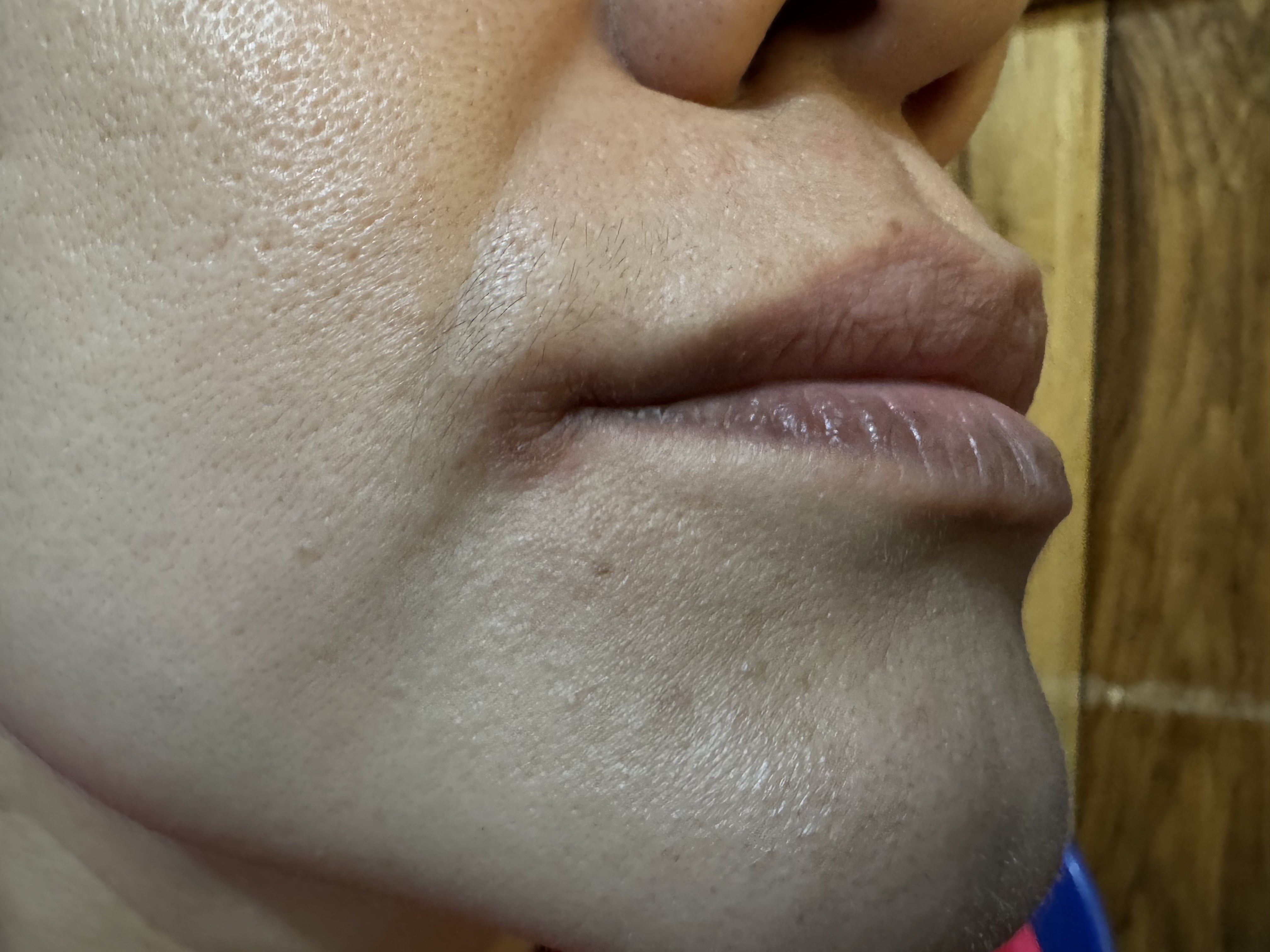 DERMATITIS POR CONTACTO - Lápiz labial