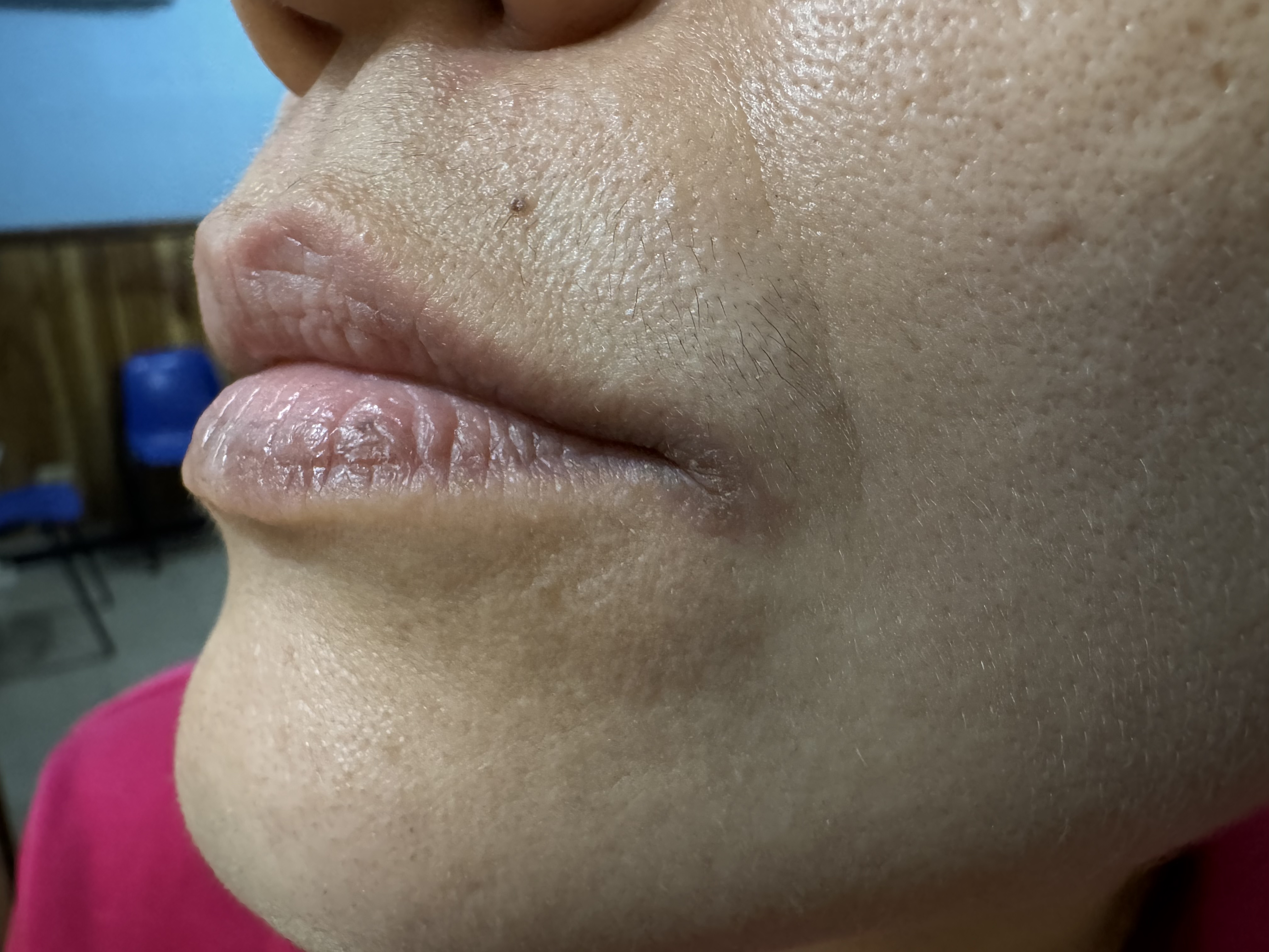 DERMATITIS POR CONTACTO - Lápiz labial