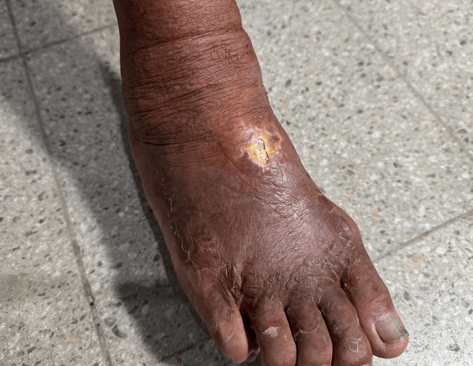 ULCERA POST OPERATORIA y Fotosensibilizacion