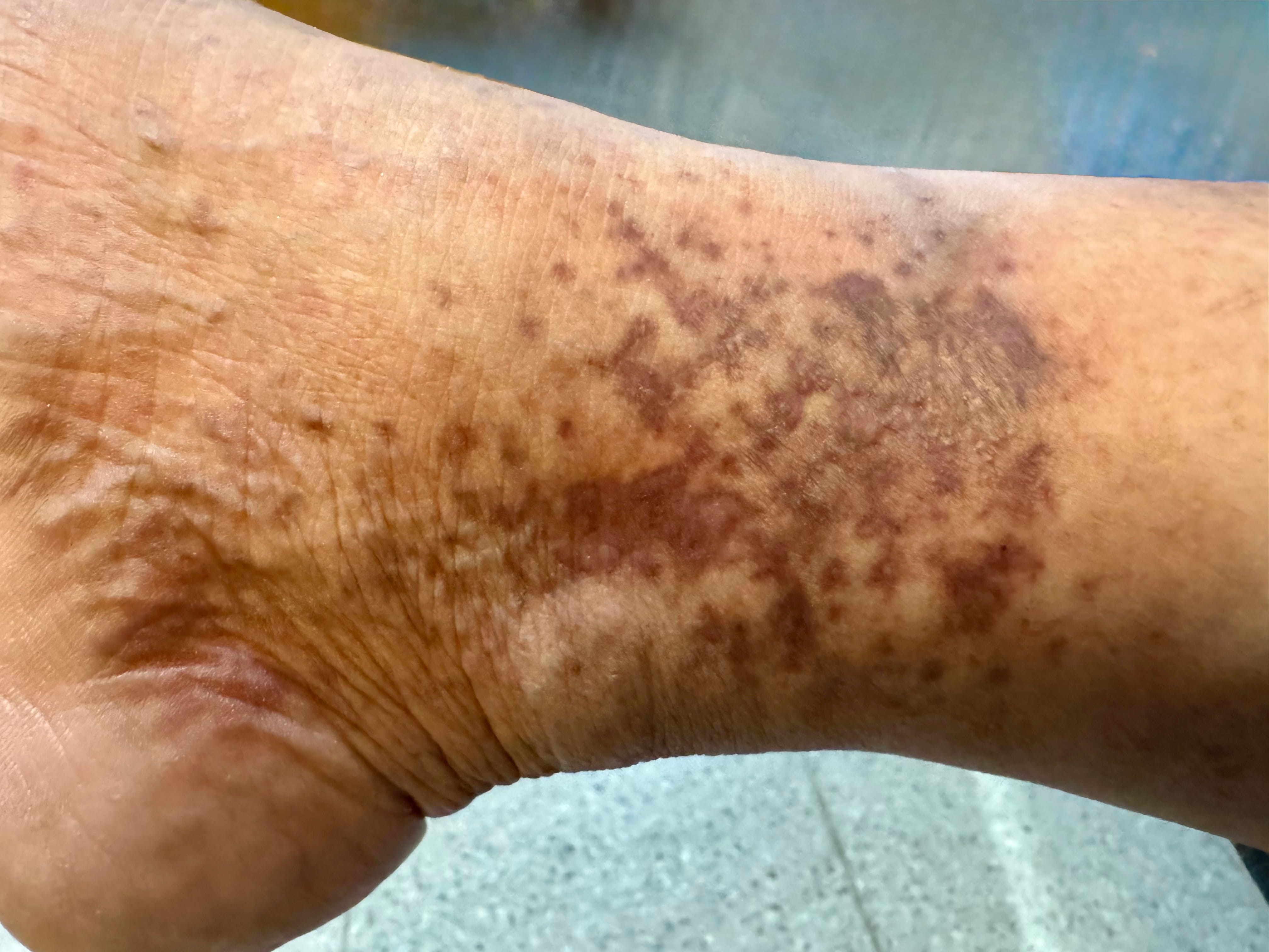 HIPERCRMIA POS LESIONAL - Varices