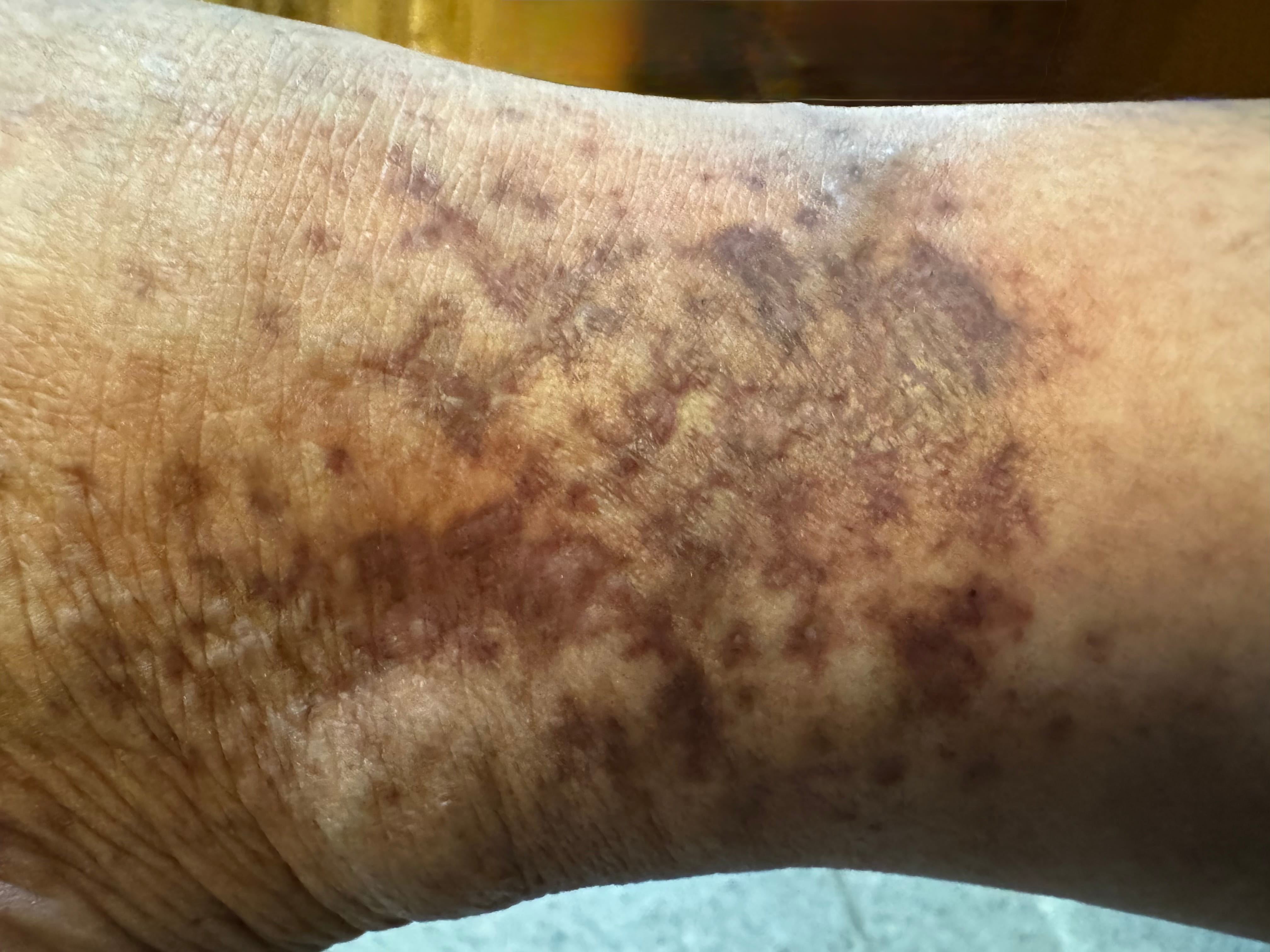 HIPERCRMIA POS LESIONAL - Varices